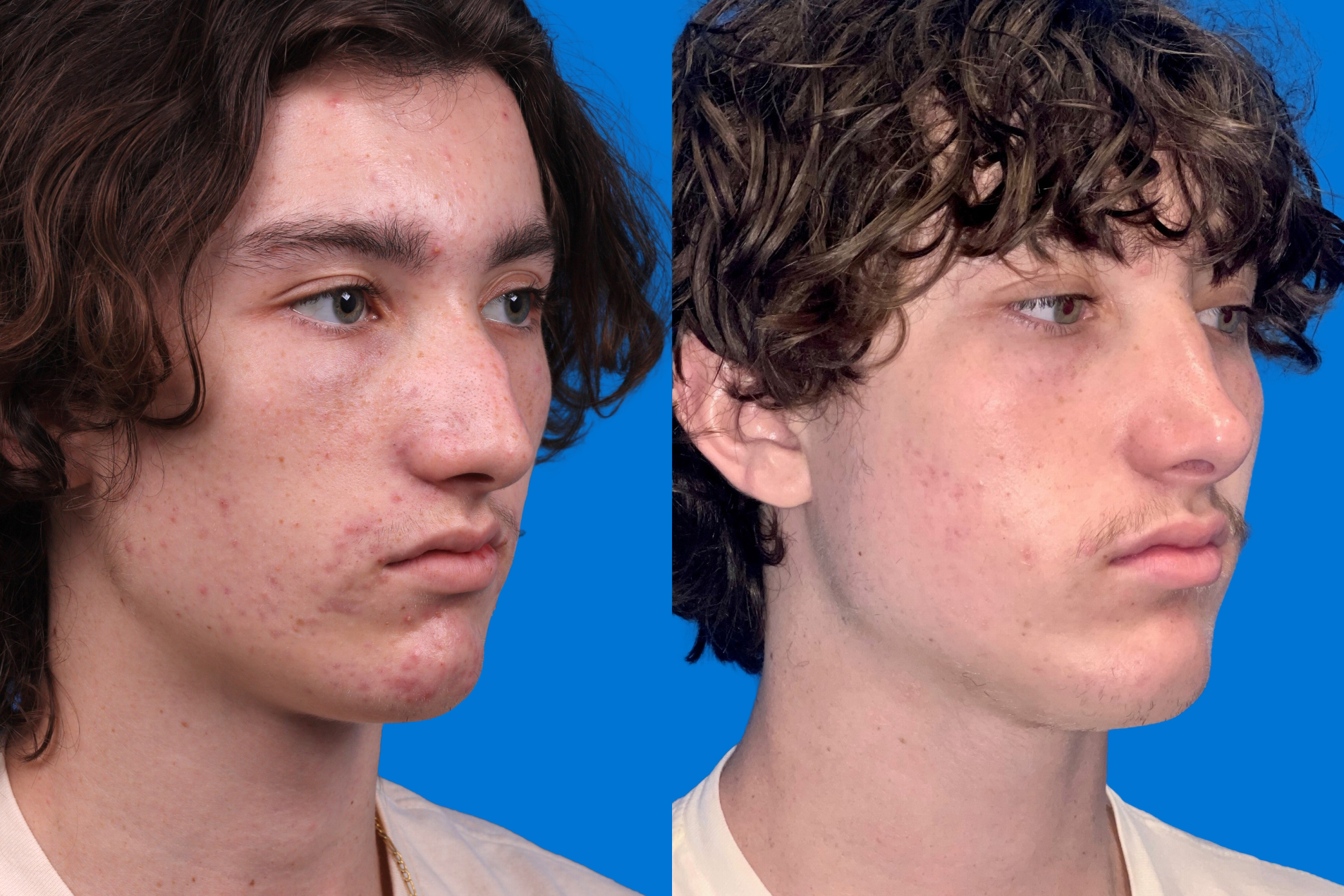 Rhinoplasty Before & After Gallery - Patient 159366 - Image 2