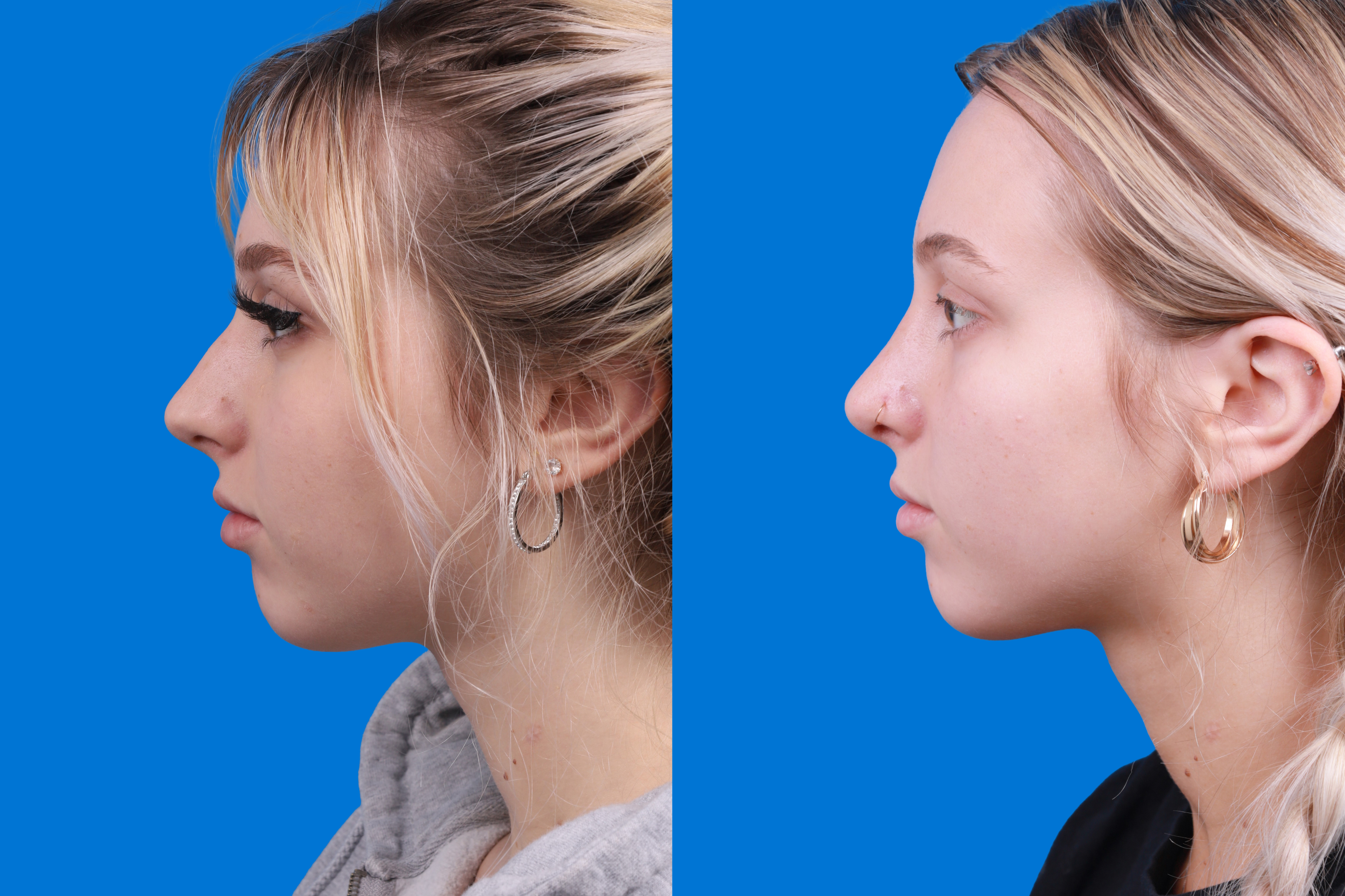 Rhinoplasty Before & After Gallery - Patient 148430547 - Image 5