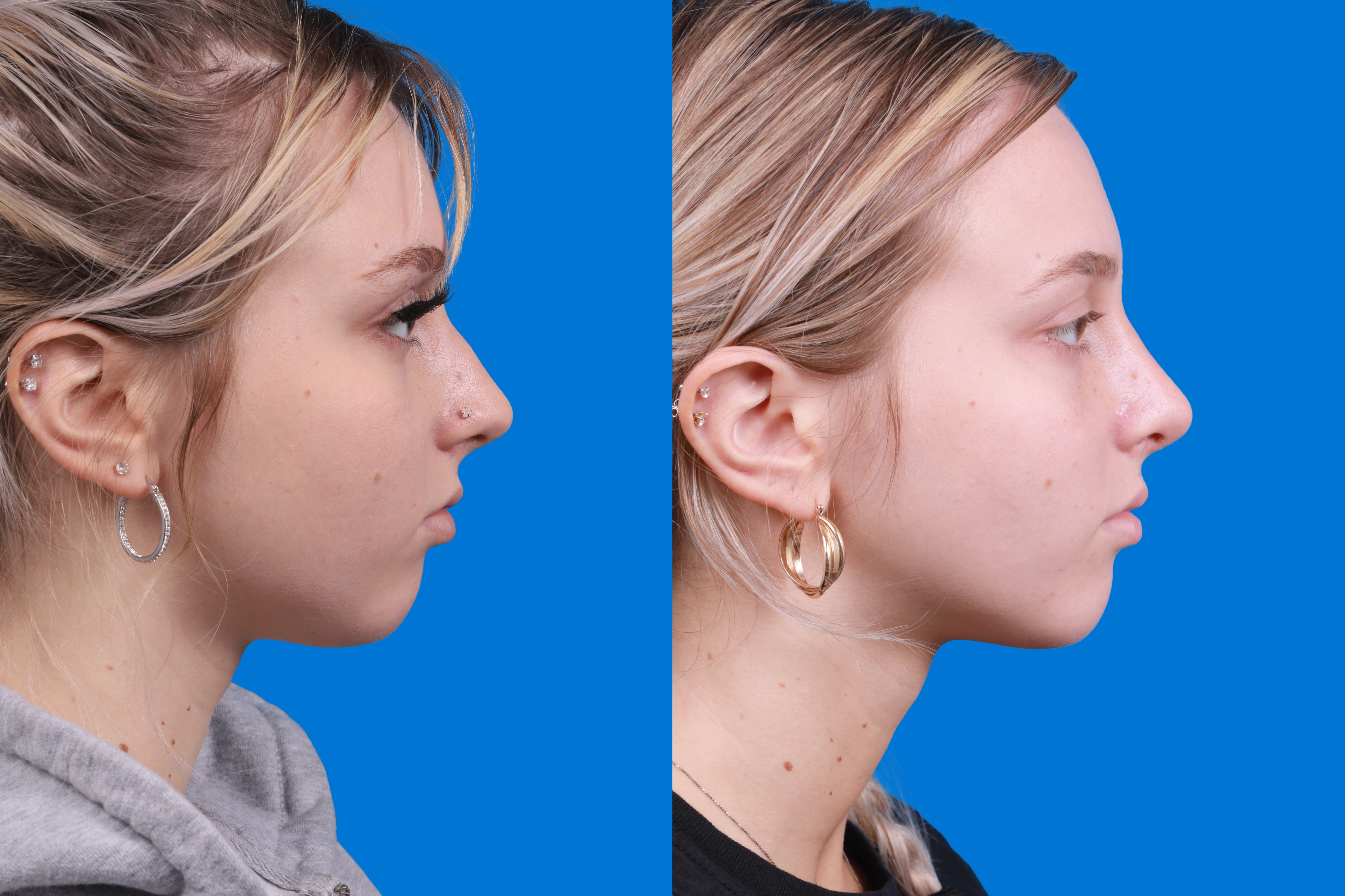 Rhinoplasty Before & After Gallery - Patient 148430547 - Image 3