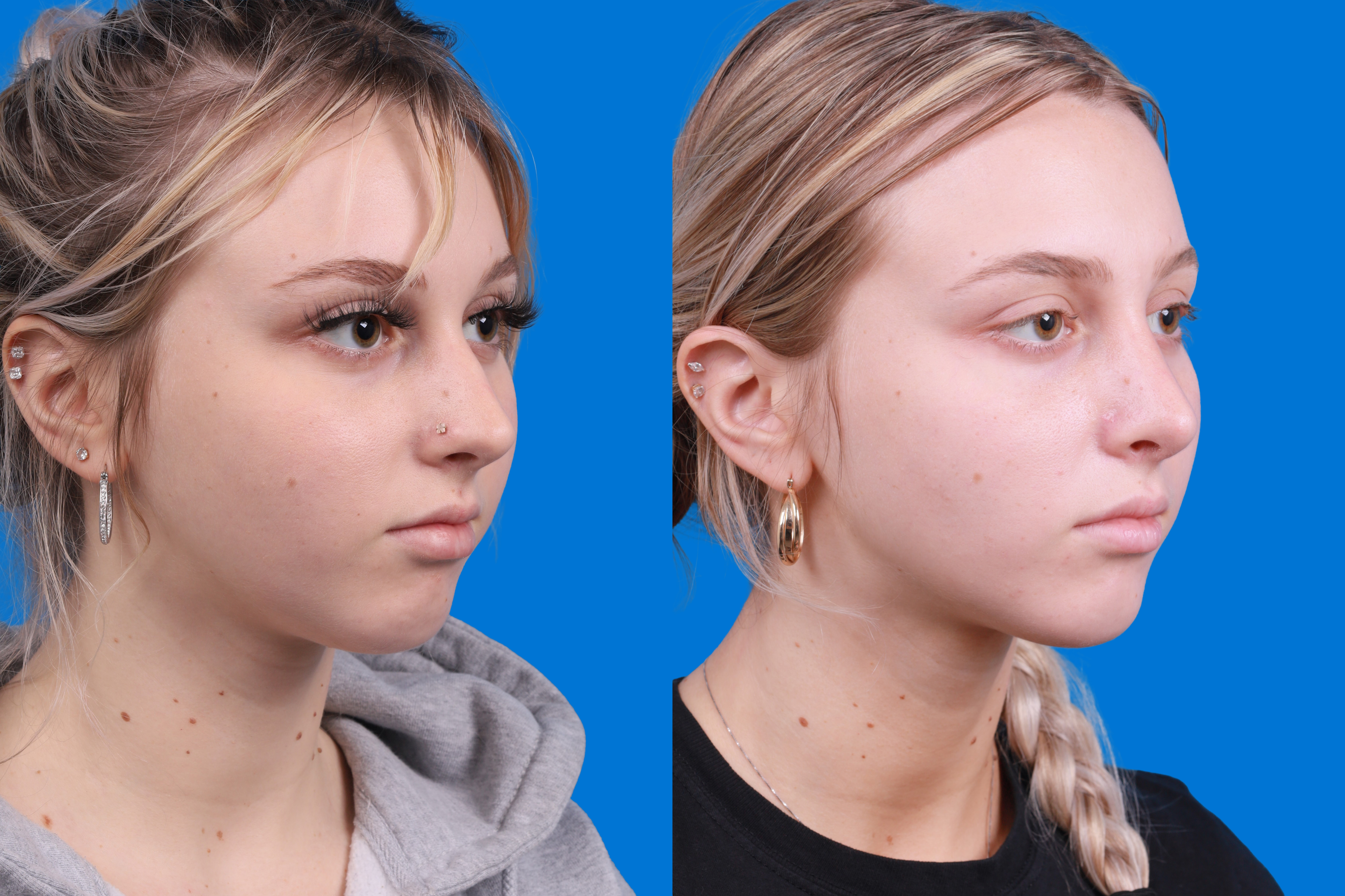 Rhinoplasty Before & After Gallery - Patient 148430547 - Image 2