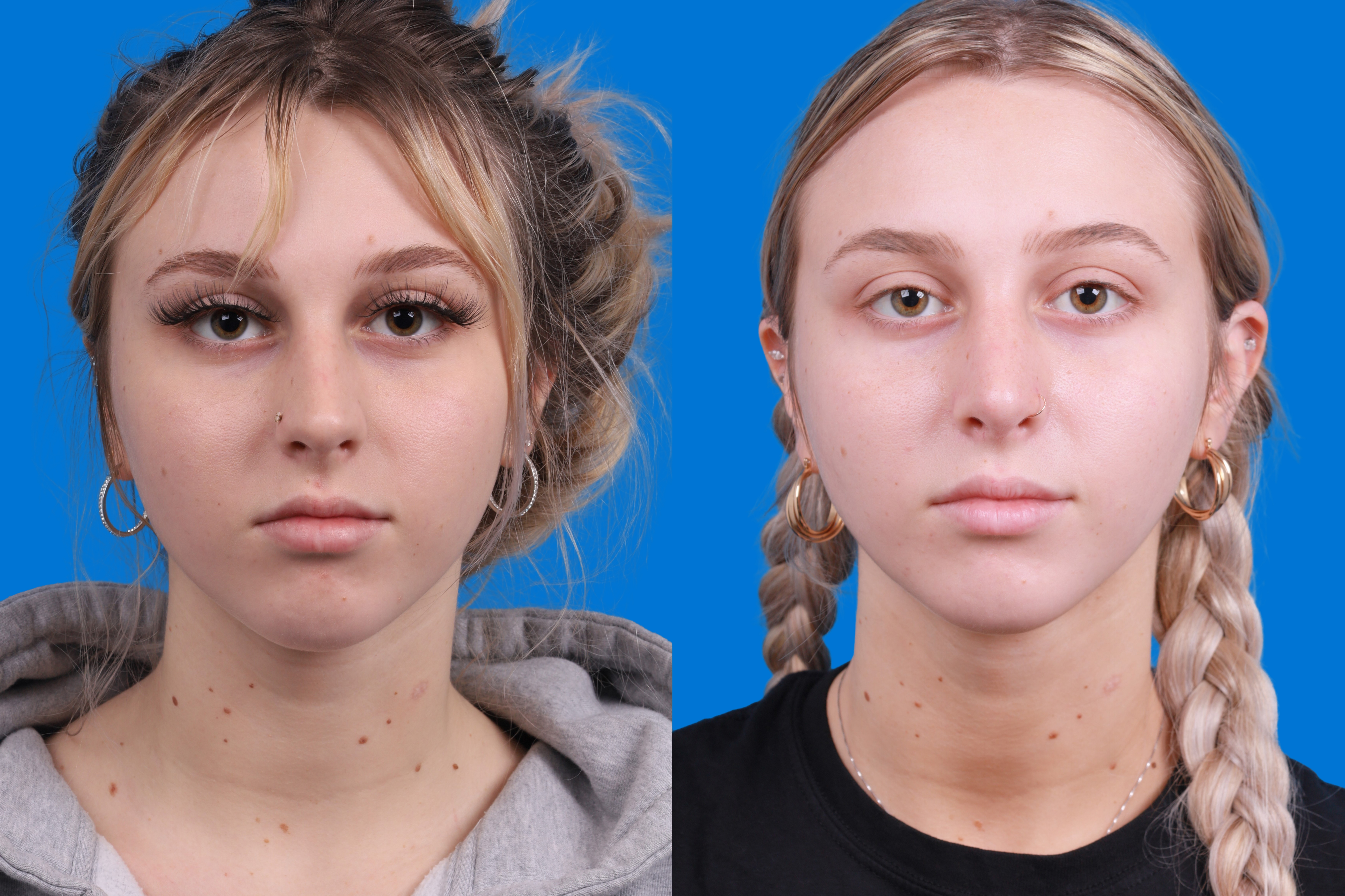 Rhinoplasty Before & After Gallery - Patient 148430547 - Image 1