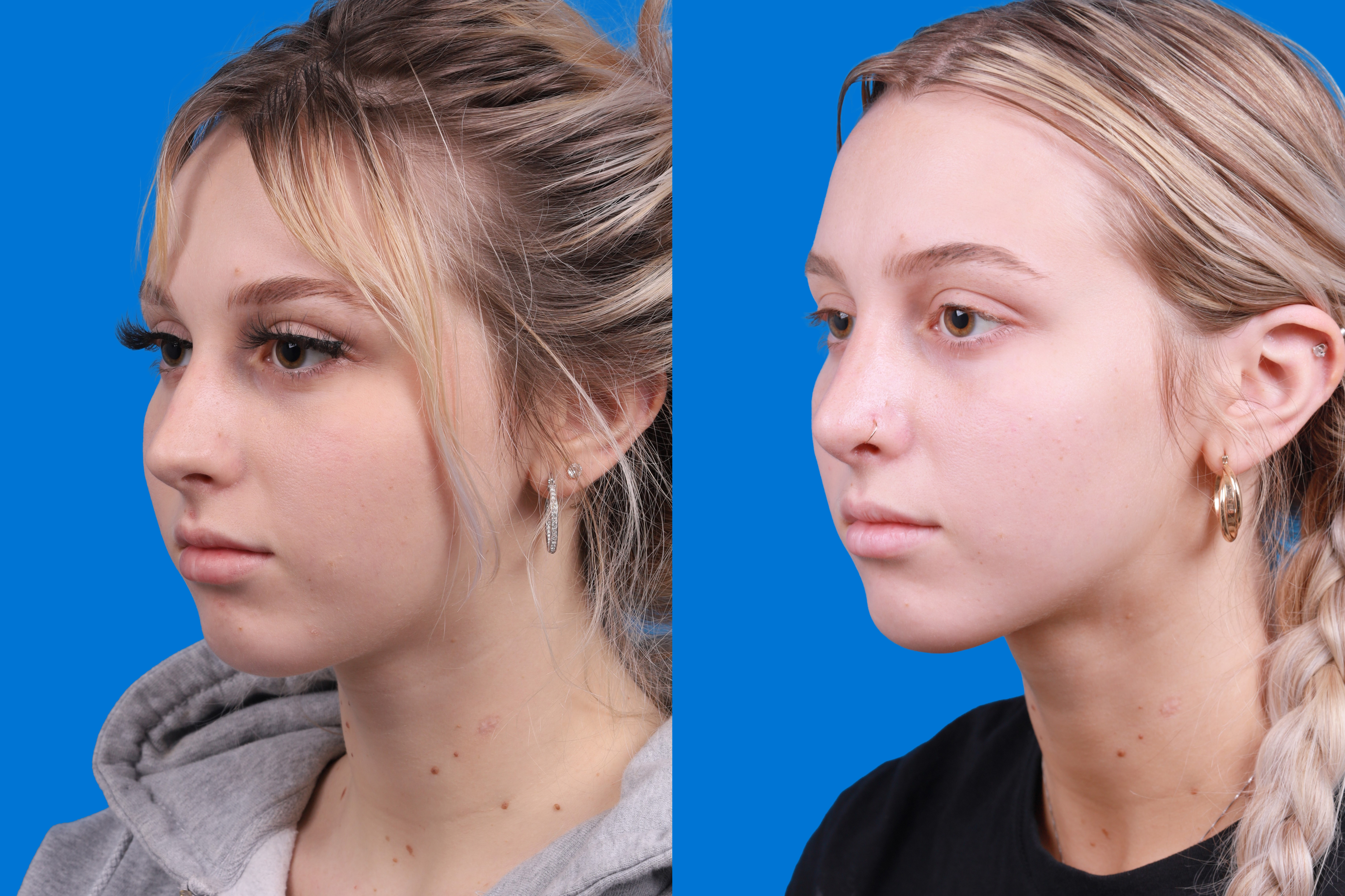 Rhinoplasty Before & After Gallery - Patient 148430547 - Image 4