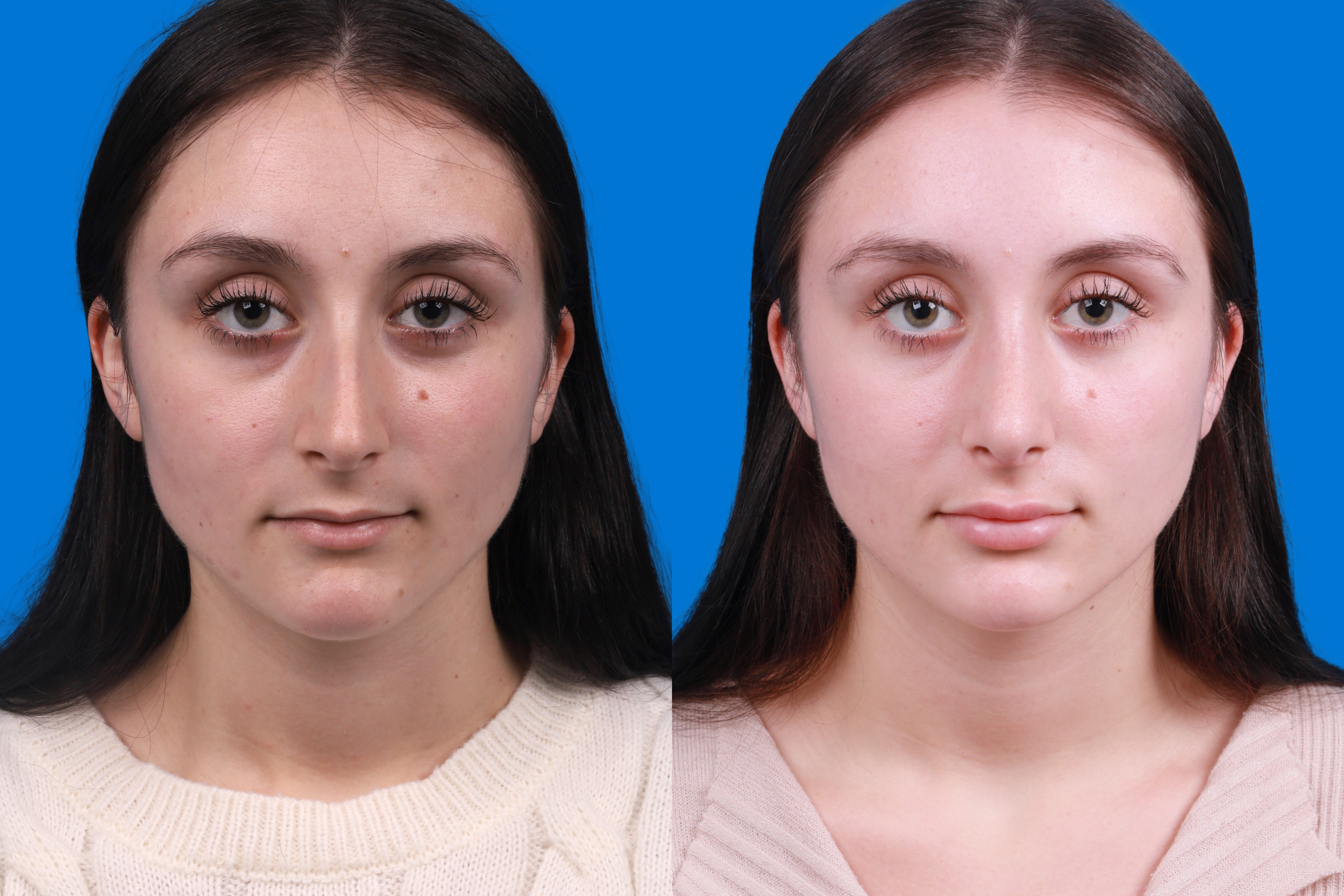 Rhinoplasty Before & After Gallery - Patient 898500 - Image 1