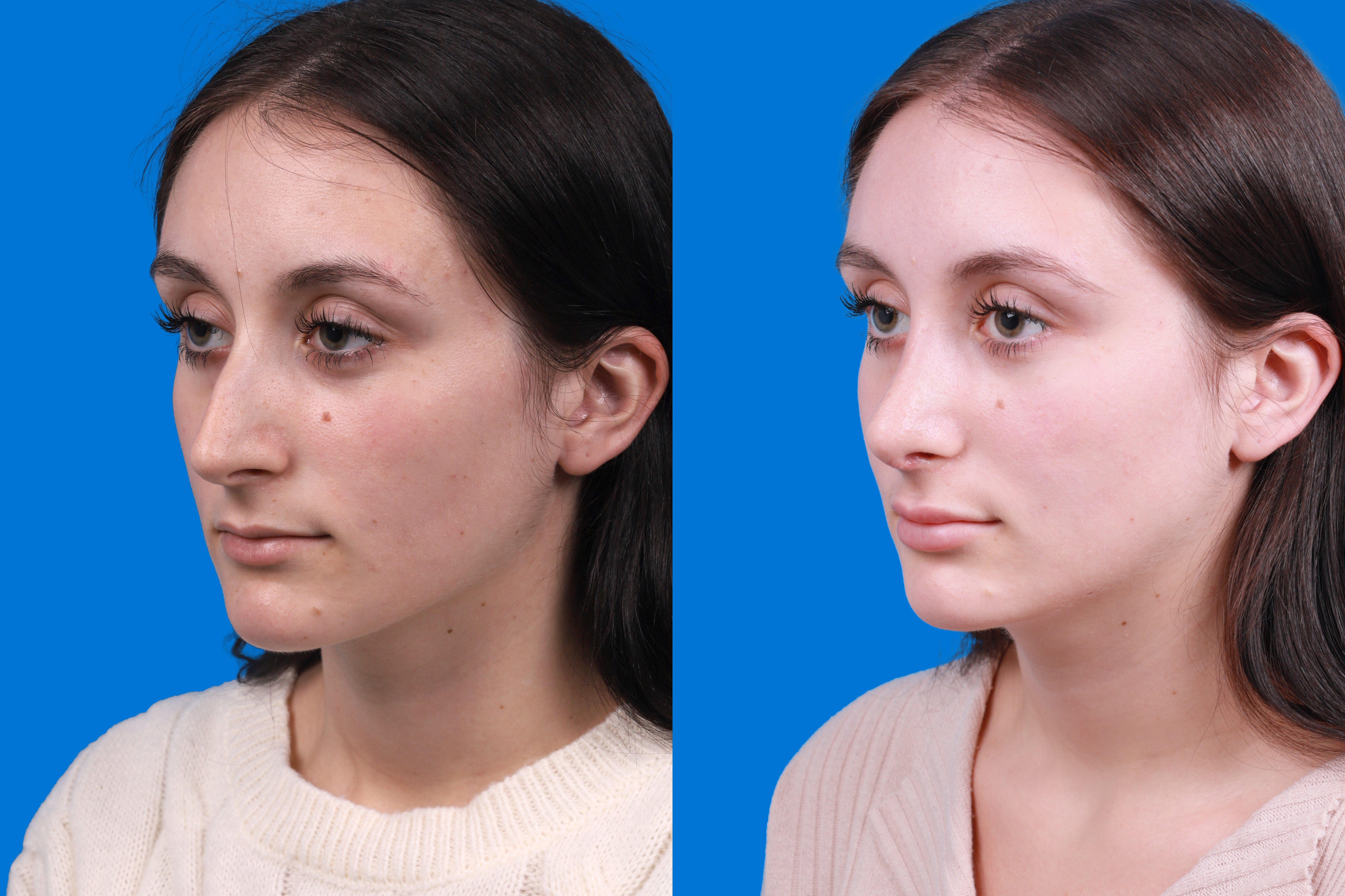 Rhinoplasty Before & After Gallery - Patient 898500 - Image 4