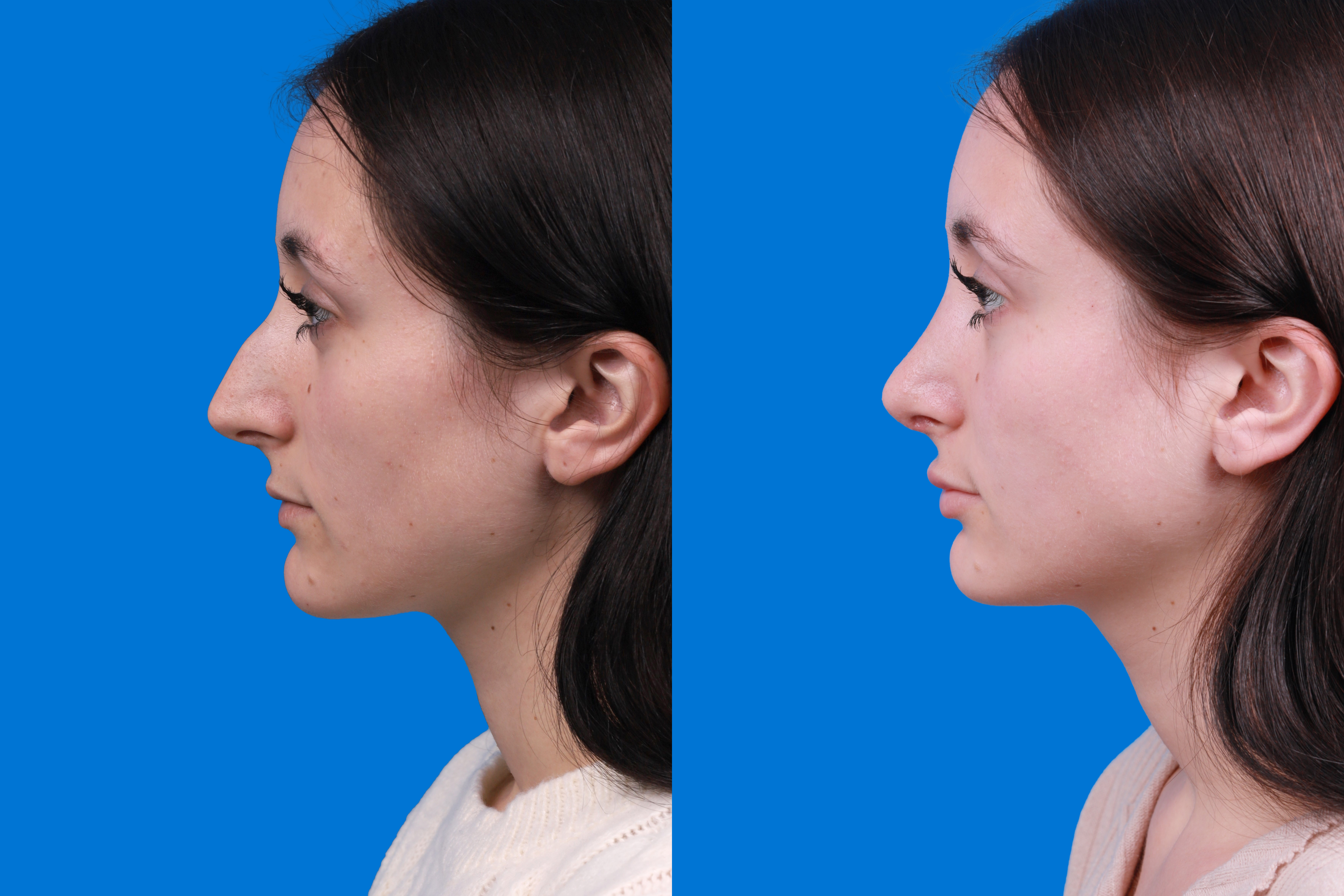 Rhinoplasty Before & After Gallery - Patient 898500 - Image 5
