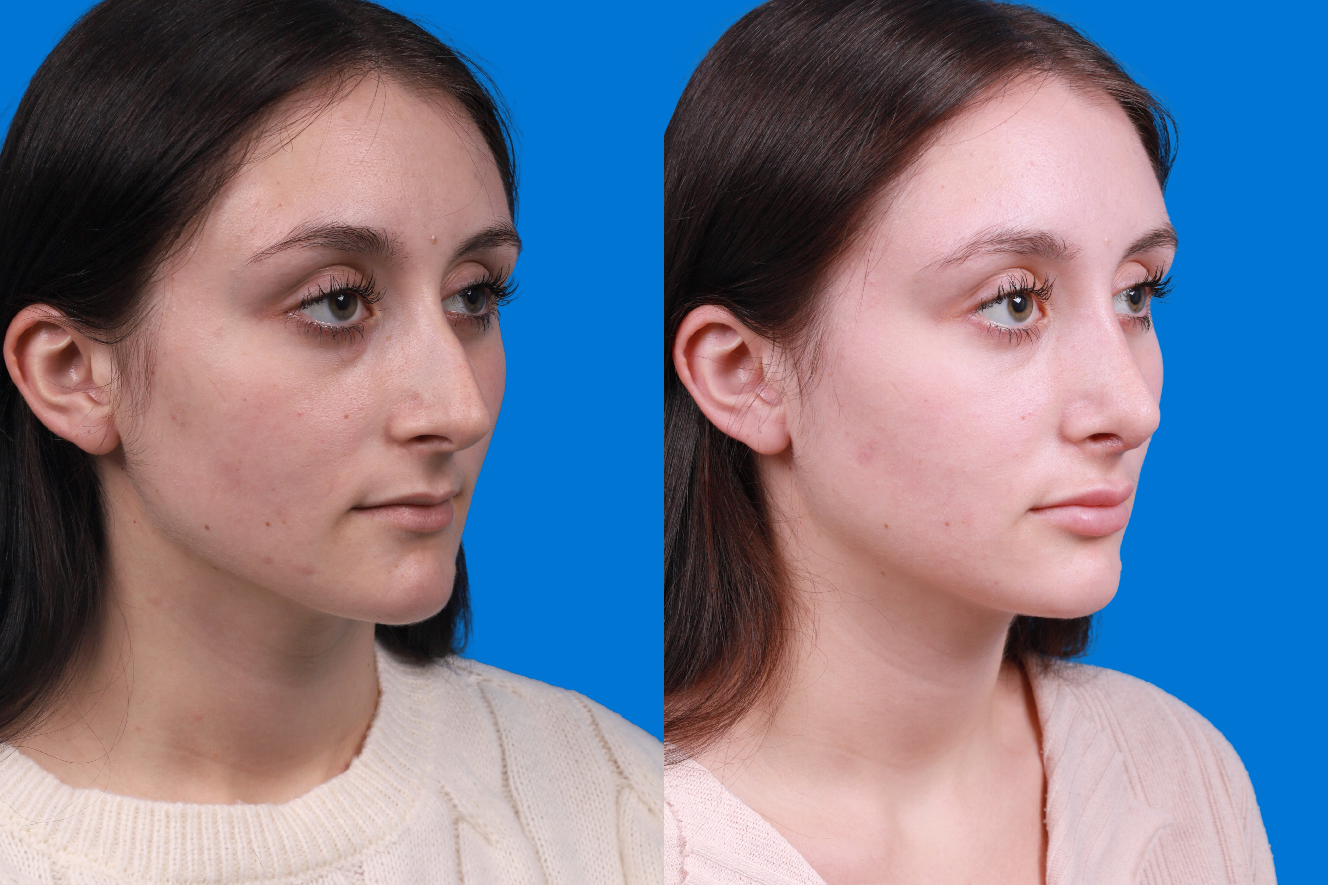 Rhinoplasty Before & After Gallery - Patient 898500 - Image 2