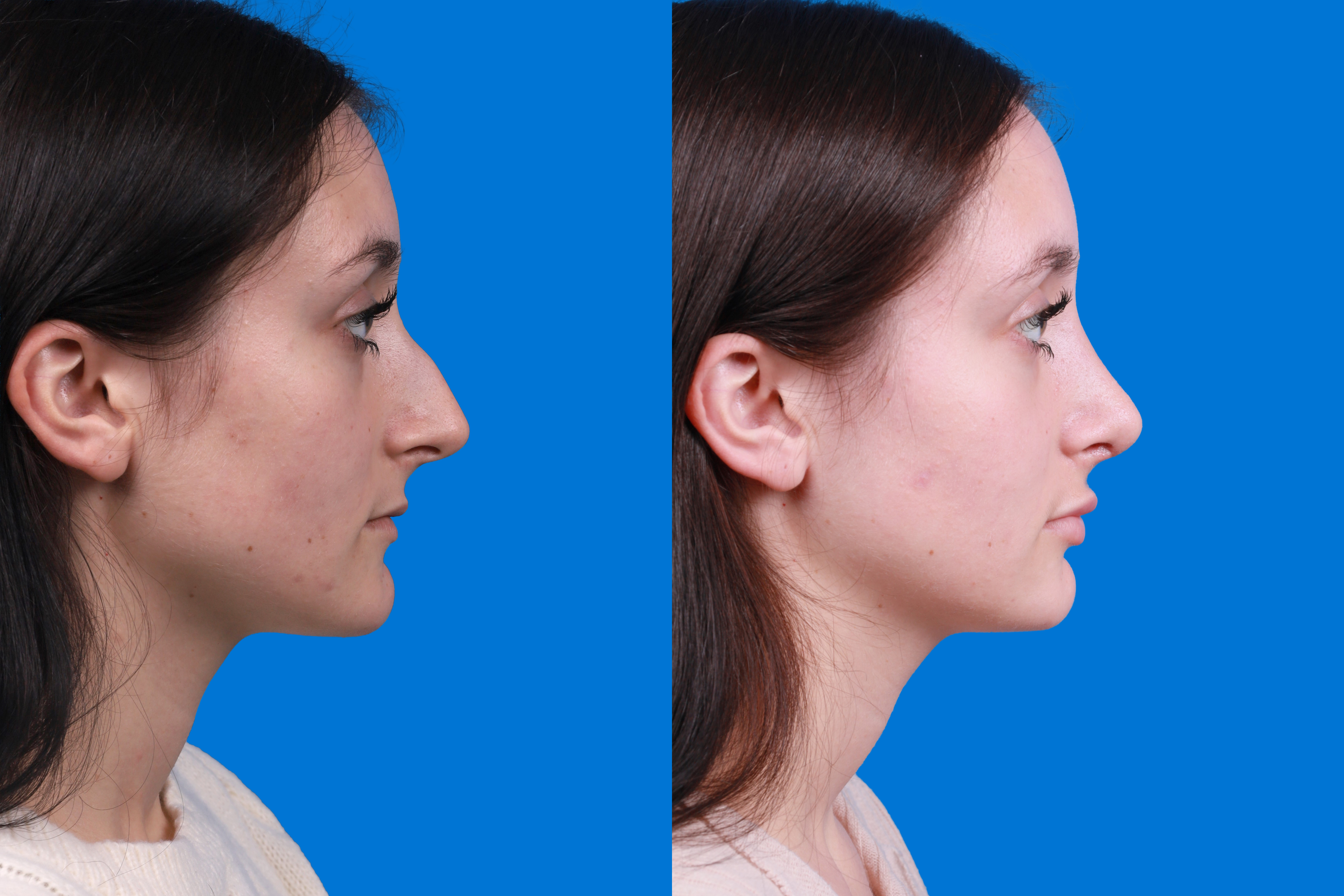 Rhinoplasty Before & After Gallery - Patient 898500 - Image 3