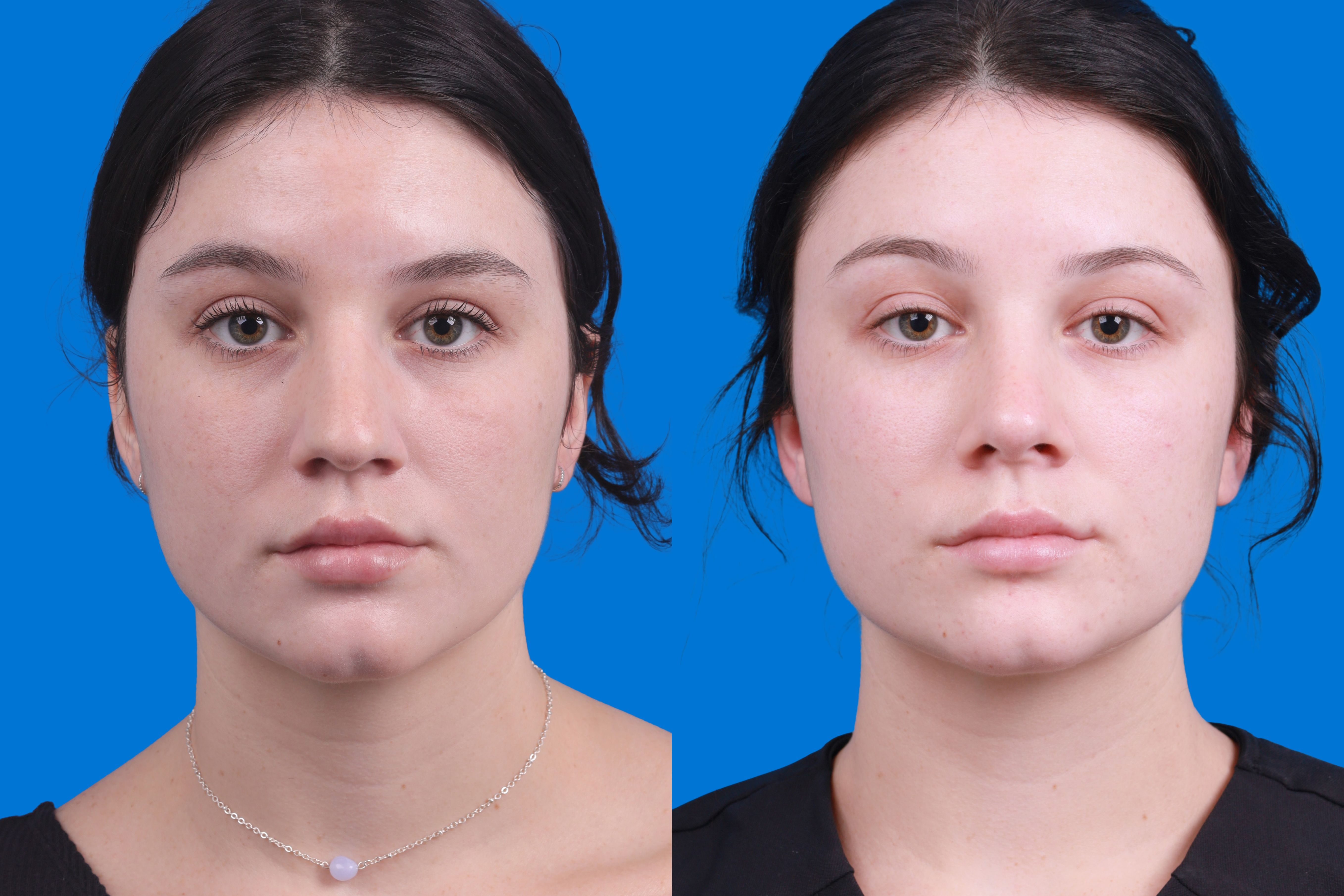 Rhinoplasty Before & After Gallery - Patient 150490831 - Image 1