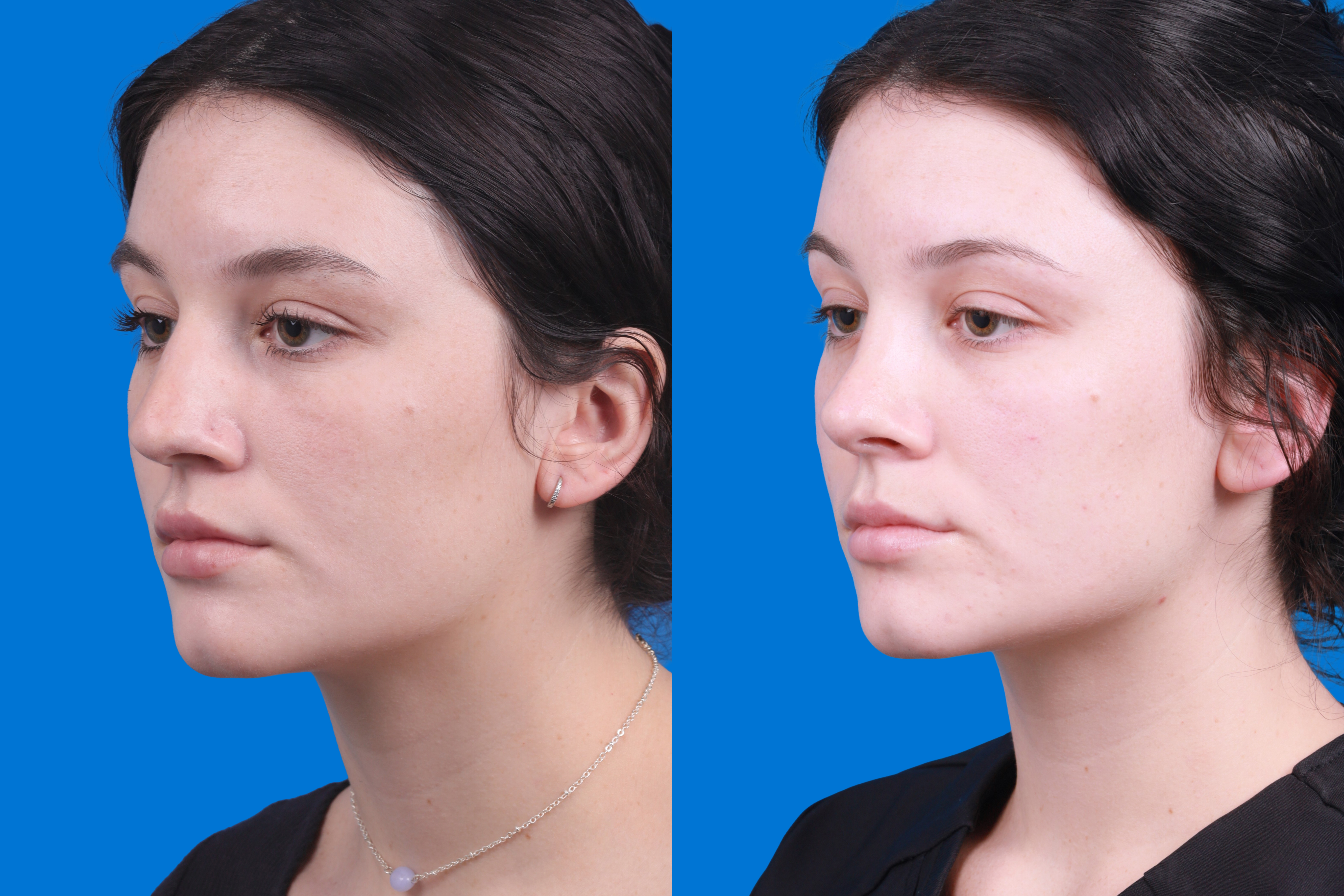 Rhinoplasty Before & After Gallery - Patient 150490831 - Image 4