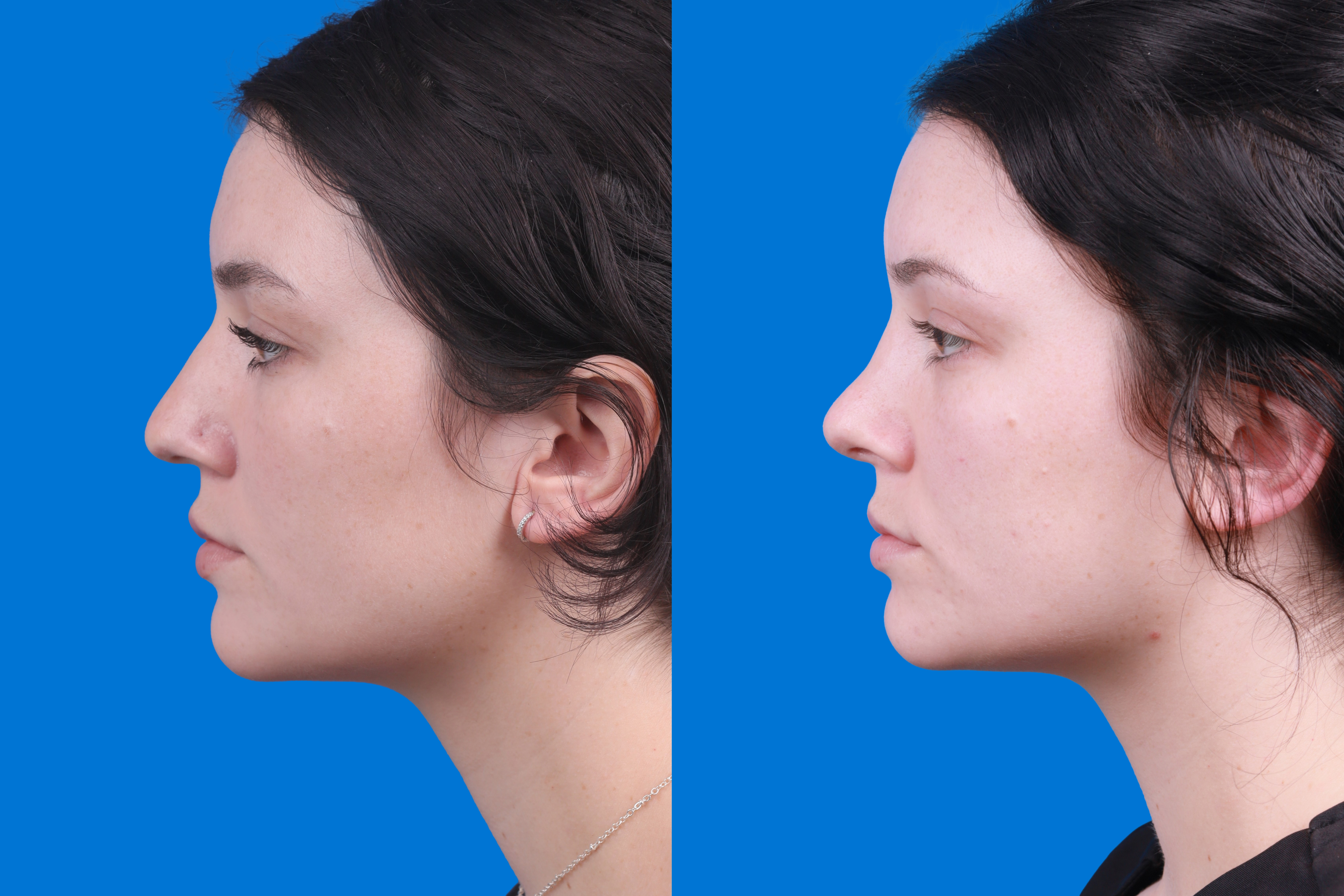 Rhinoplasty Before & After Gallery - Patient 150490831 - Image 5