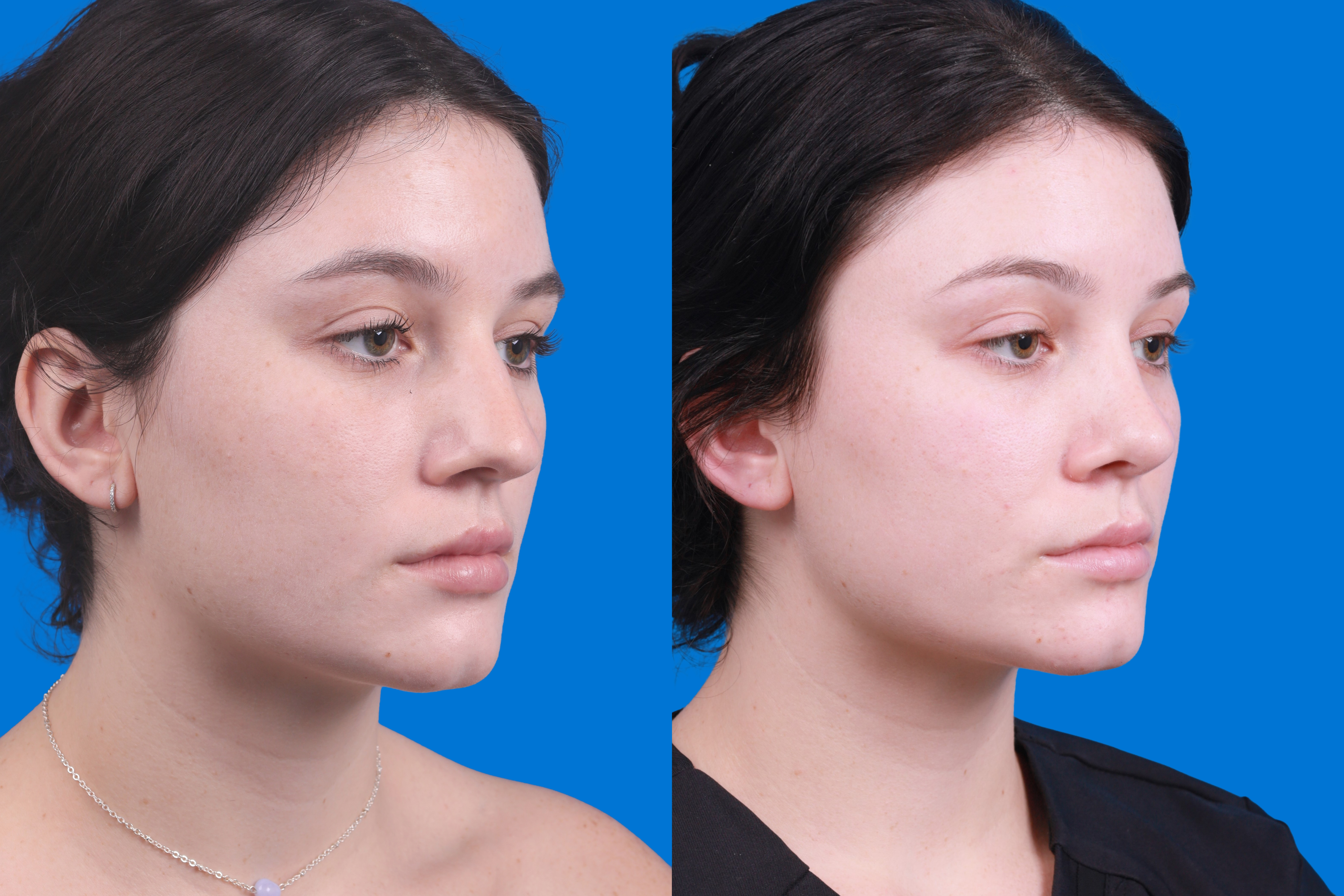 Rhinoplasty Before & After Gallery - Patient 150490831 - Image 2