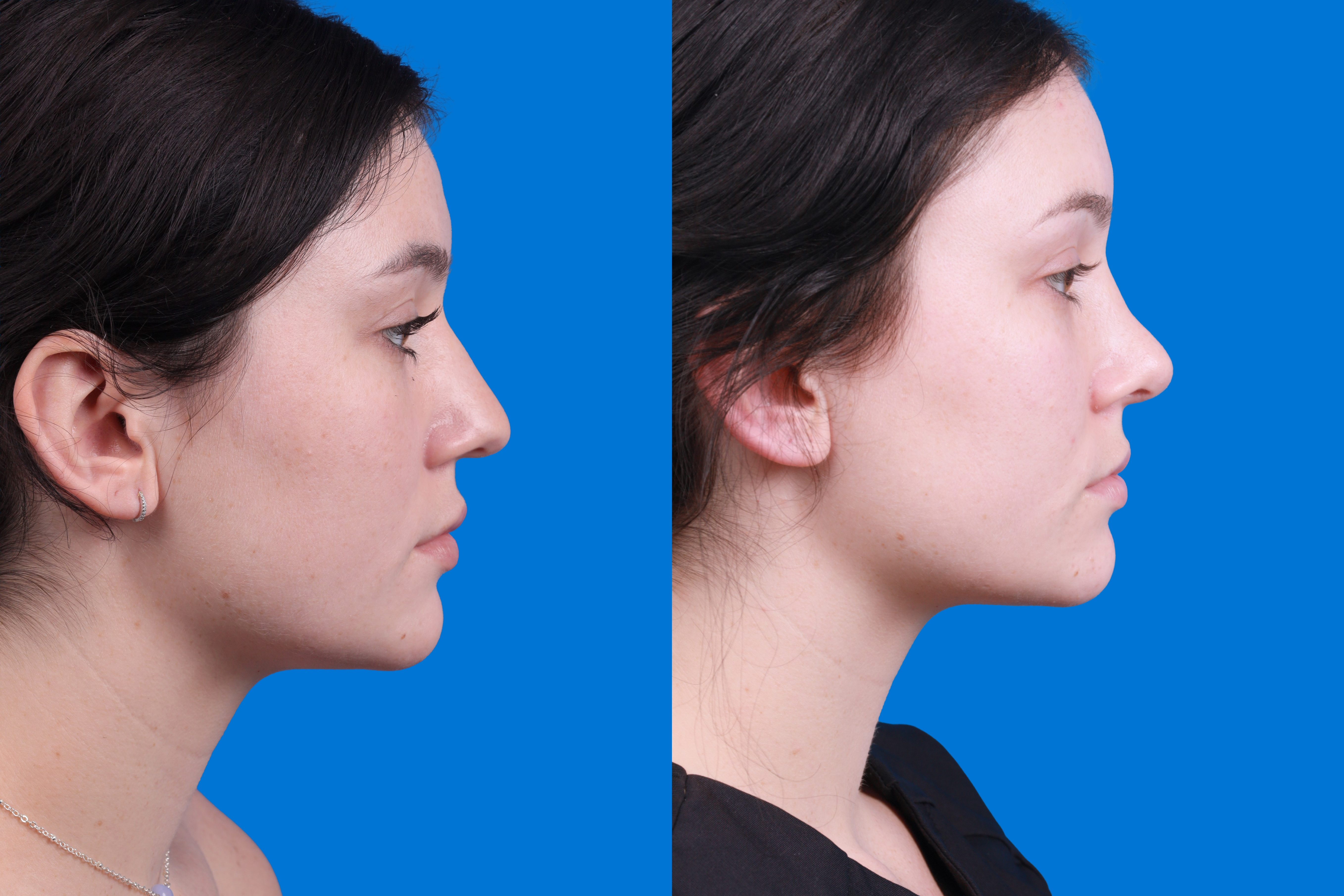 Rhinoplasty Before & After Gallery - Patient 150490831 - Image 3