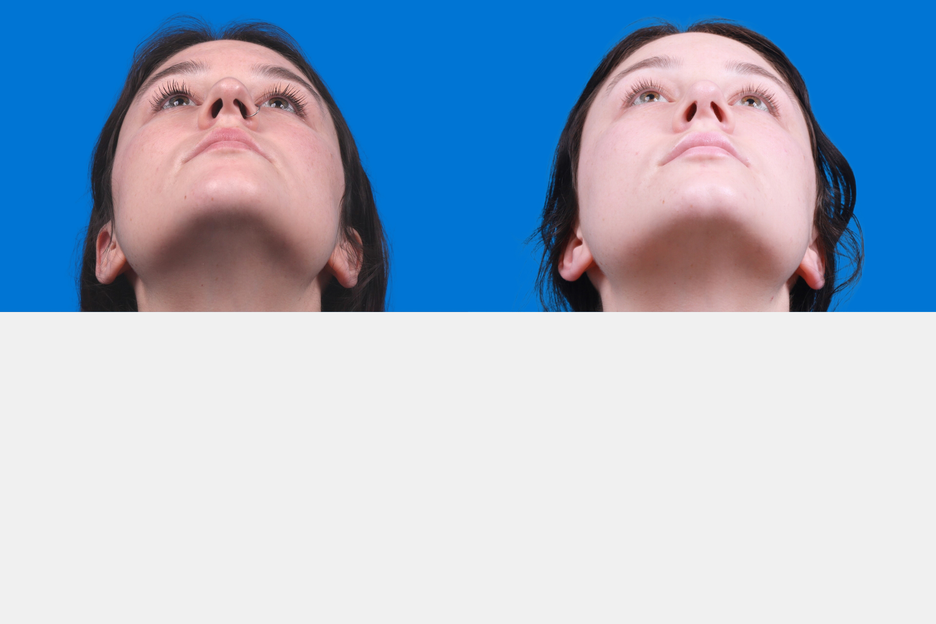 Rhinoplasty Before & After Gallery - Patient 150490831 - Image 6