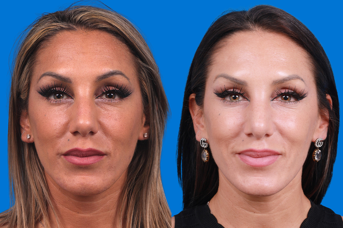 Rhinoplasty Before & After Gallery - Patient 160571918 - Image 1