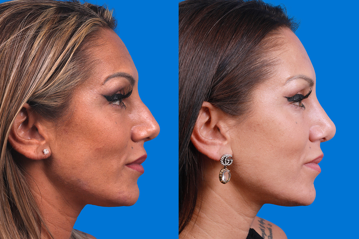 Rhinoplasty Before & After Gallery - Patient 160571918 - Image 3