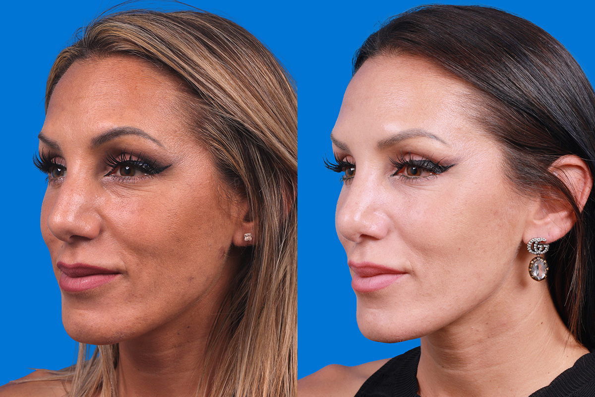Rhinoplasty Before & After Gallery - Patient 160571918 - Image 4
