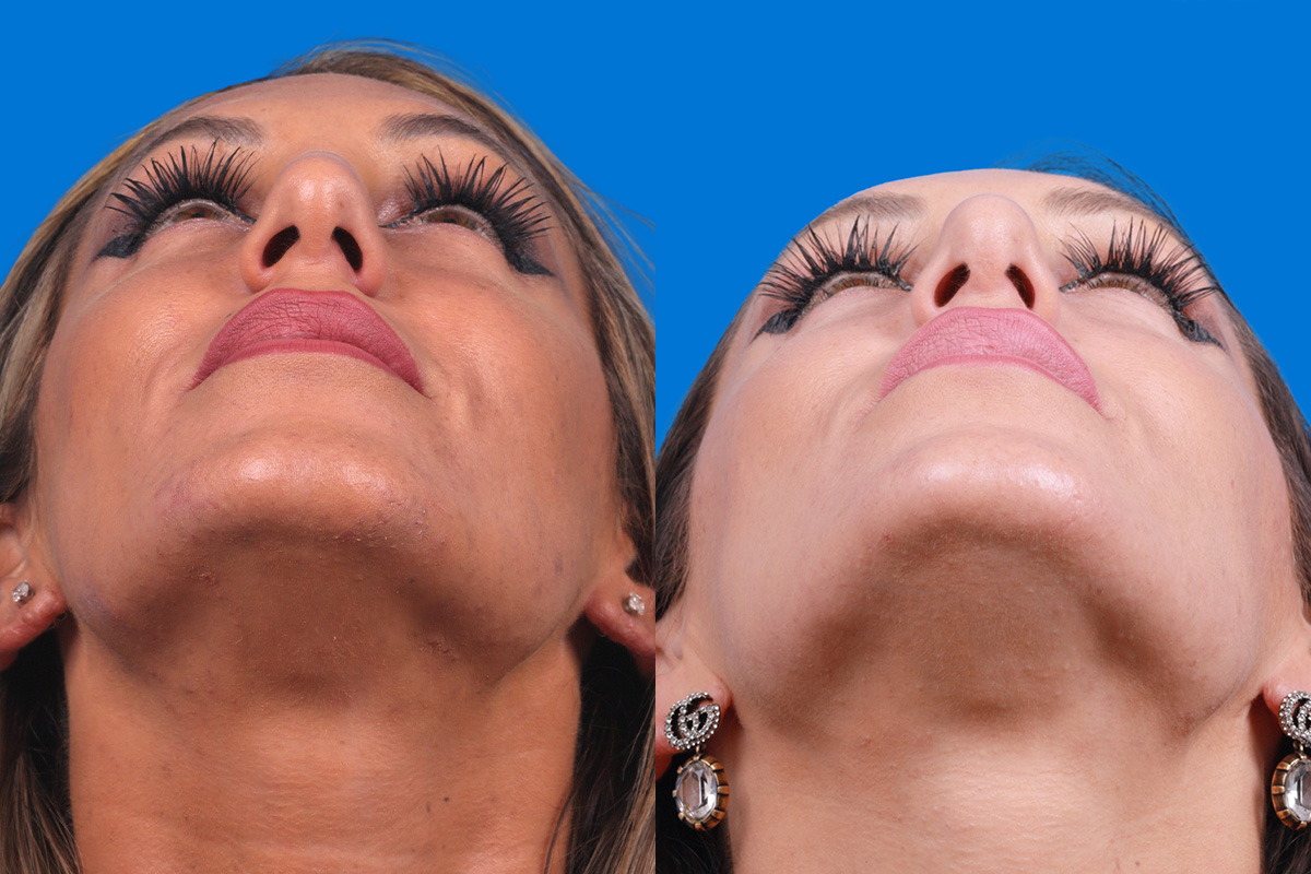 Rhinoplasty Before & After Gallery - Patient 160571918 - Image 6