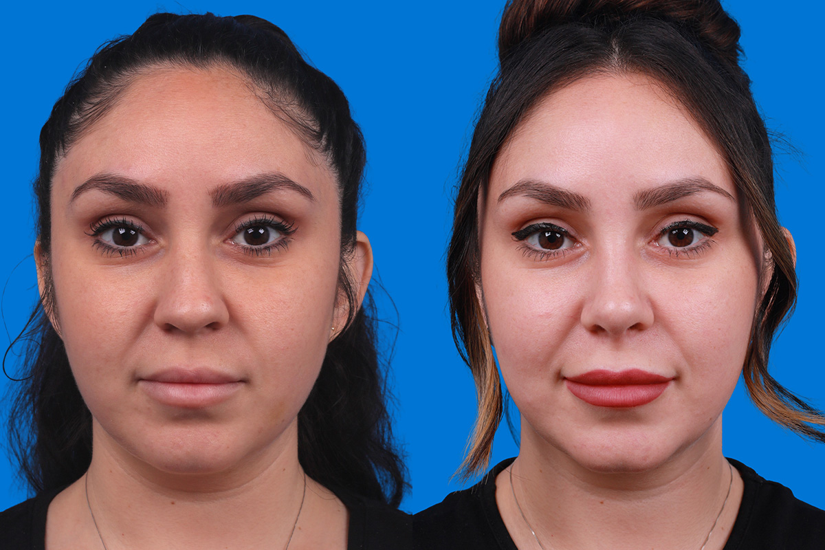 Rhinoplasty Before & After Gallery - Patient 148679015 - Image 1