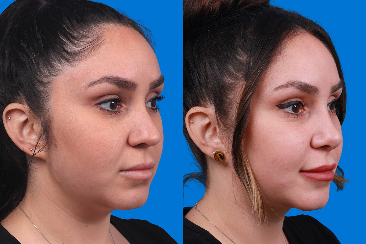 Rhinoplasty Before & After Gallery - Patient 148679015 - Image 2