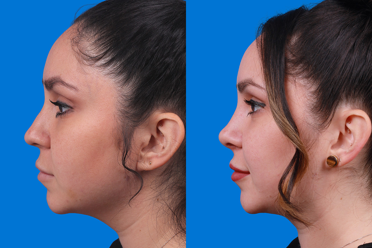 Rhinoplasty Before & After Gallery - Patient 148679015 - Image 5