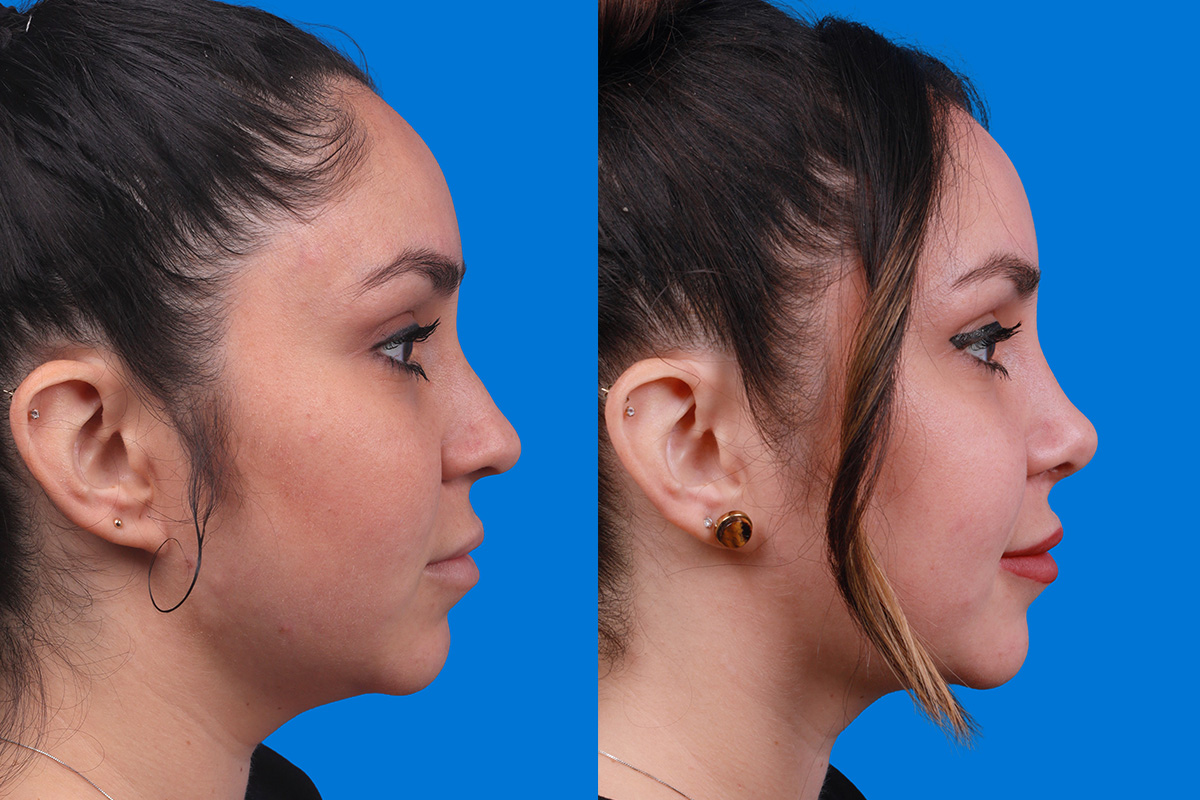 Rhinoplasty Before & After Gallery - Patient 148679015 - Image 3