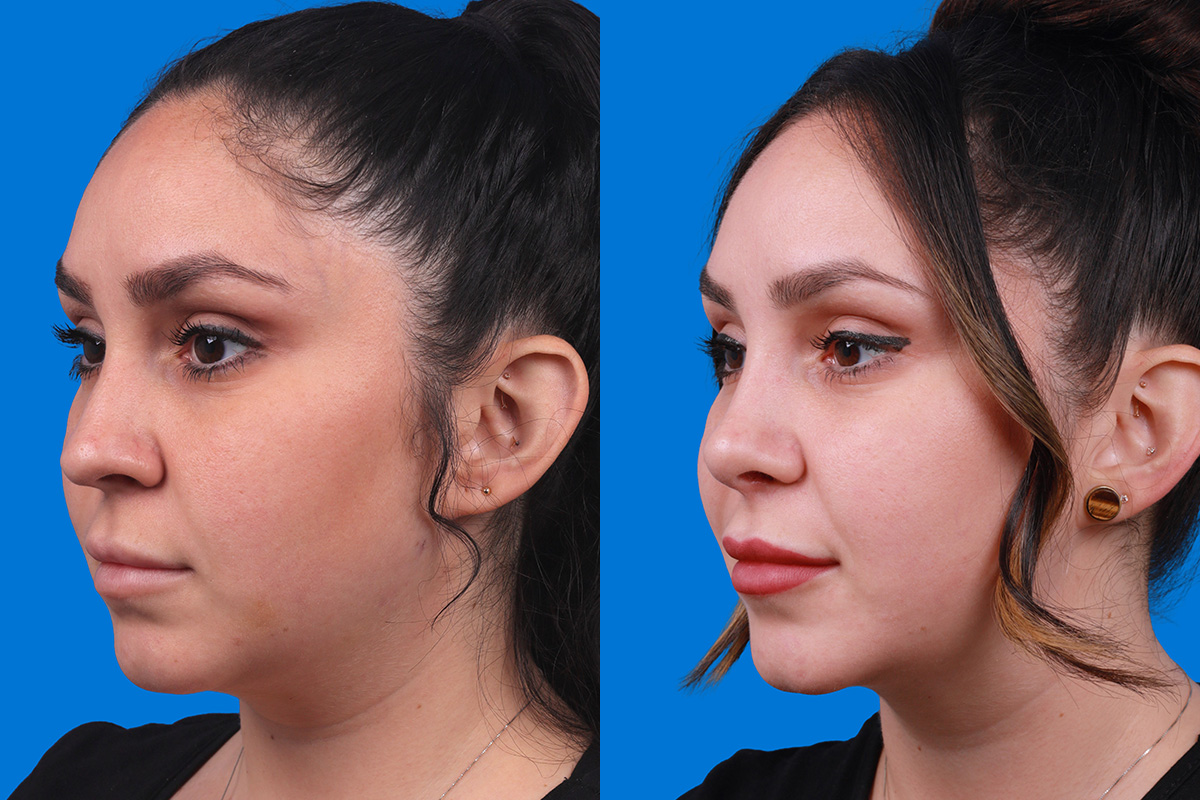 Rhinoplasty Before & After Gallery - Patient 148679015 - Image 4