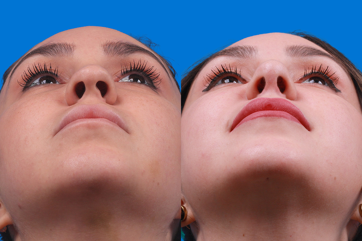Rhinoplasty Before & After Gallery - Patient 148679015 - Image 6