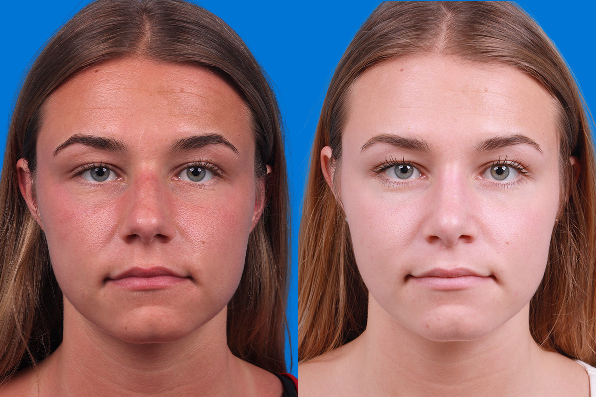 Rhinoplasty Before & After Gallery - Patient 154776513 - Image 1