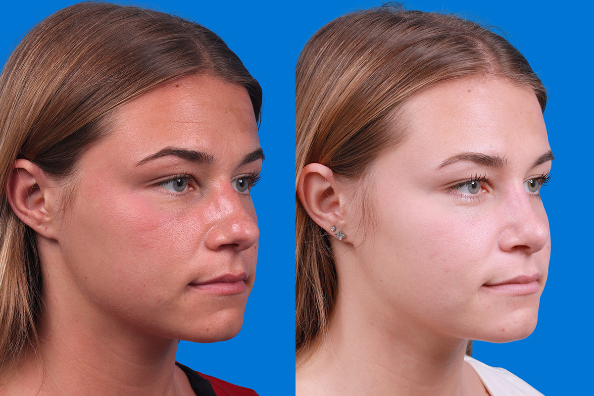 Rhinoplasty Before & After Gallery - Patient 154776513 - Image 2