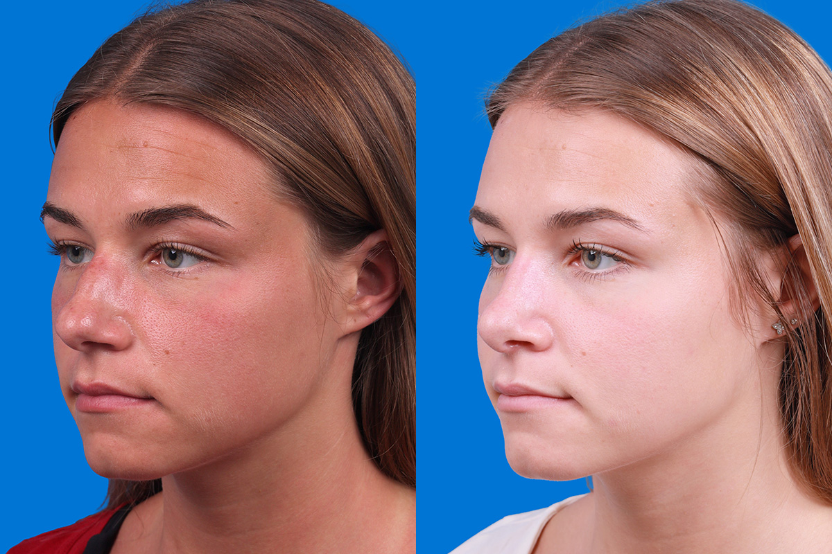 Rhinoplasty Before & After Gallery - Patient 154776513 - Image 4