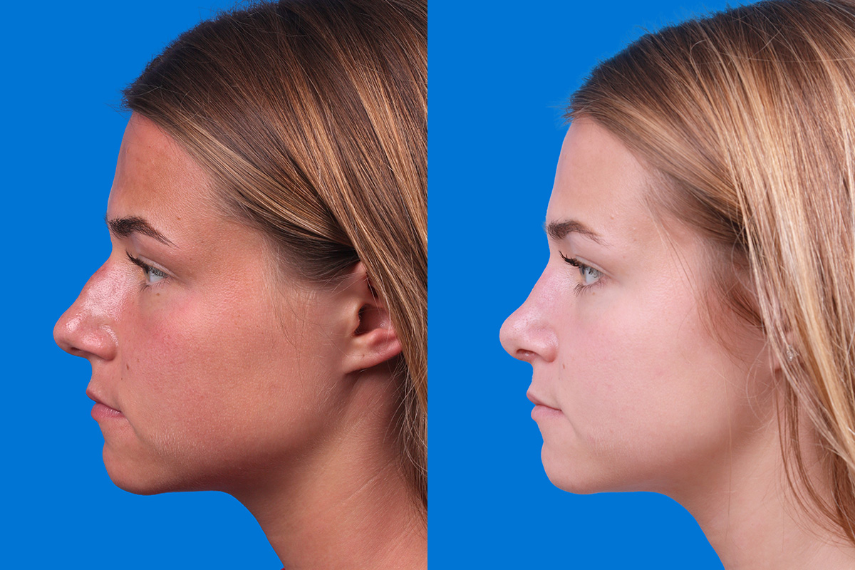 Rhinoplasty Before & After Gallery - Patient 154776513 - Image 5