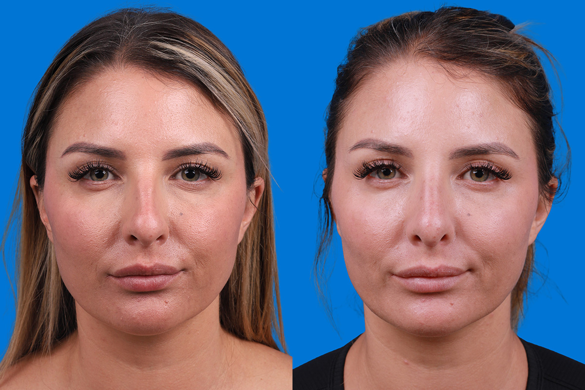 Rhinoplasty Before & After Gallery - Patient 354909 - Image 1