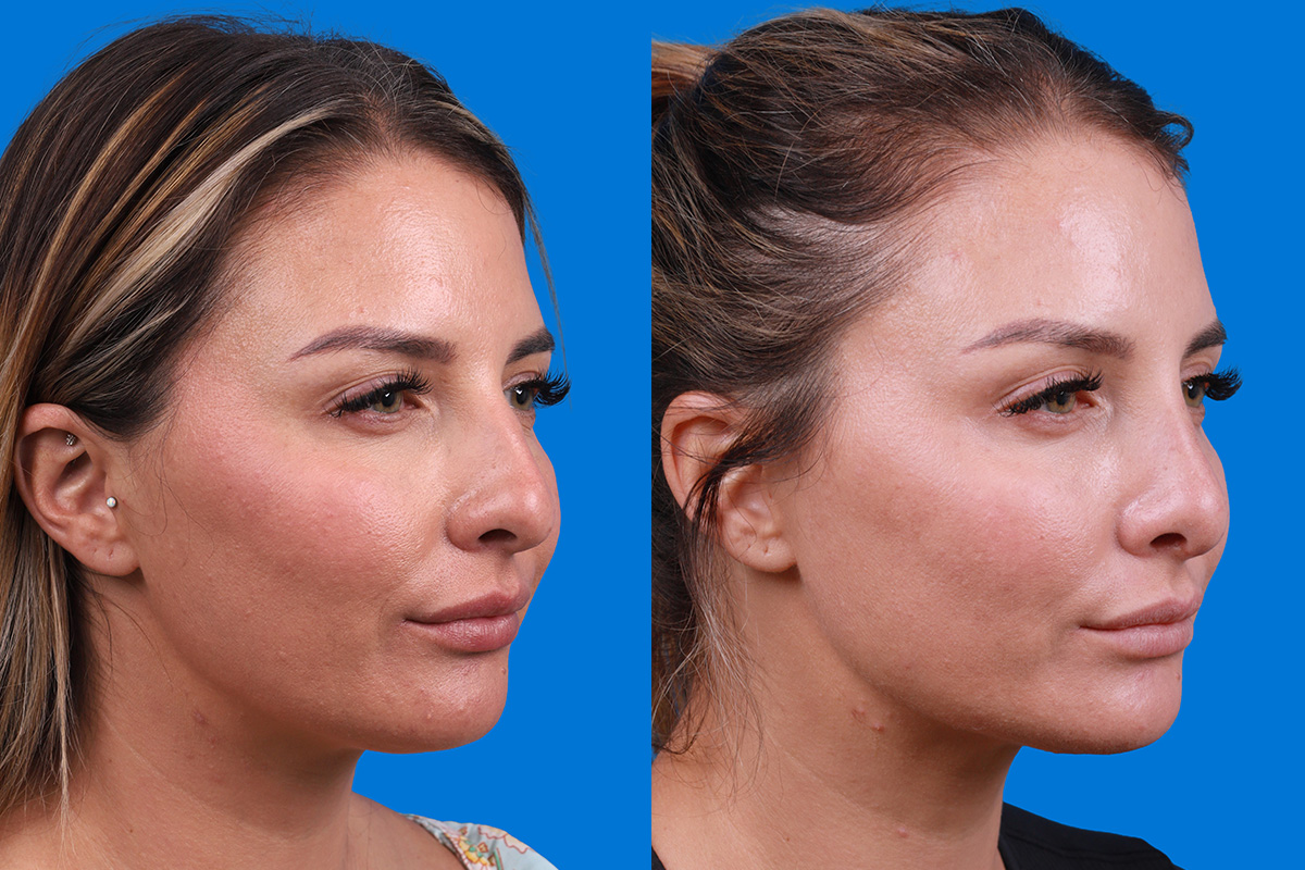 Rhinoplasty Before & After Gallery - Patient 354909 - Image 2