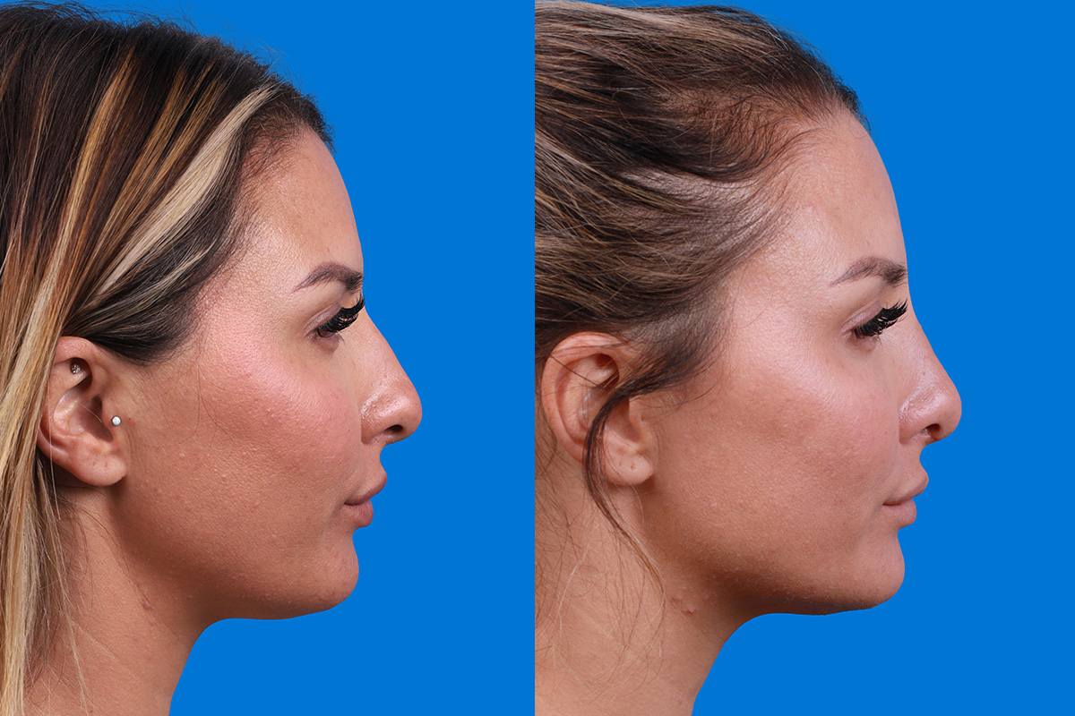 Rhinoplasty Before & After Gallery - Patient 354909 - Image 3