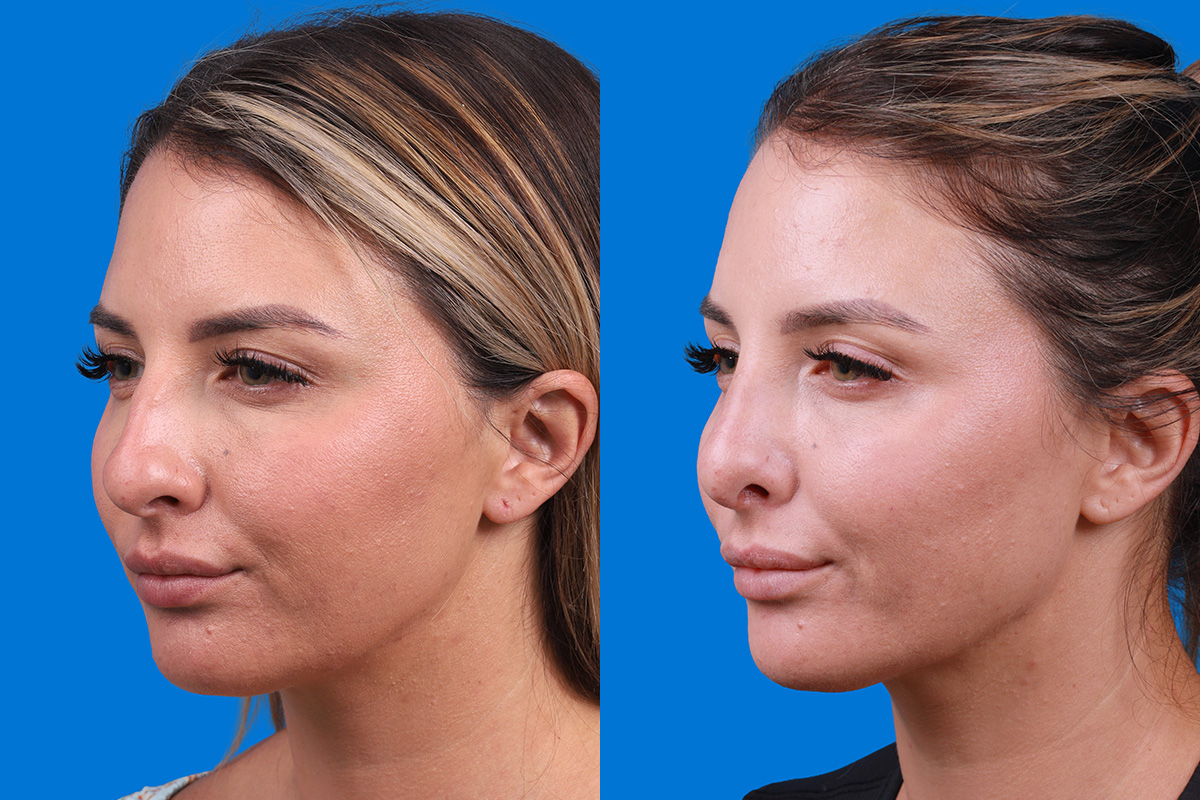 Rhinoplasty Before & After Gallery - Patient 354909 - Image 4