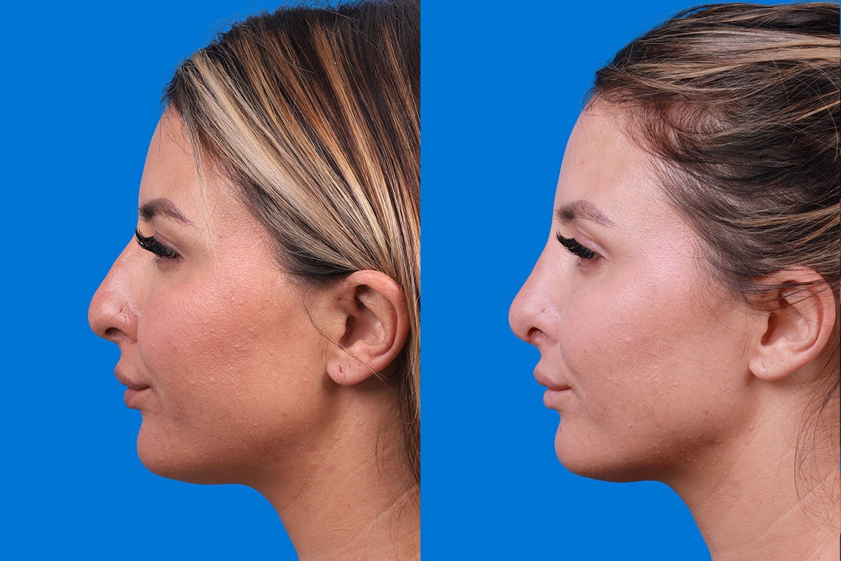Rhinoplasty Before & After Gallery - Patient 354909 - Image 5