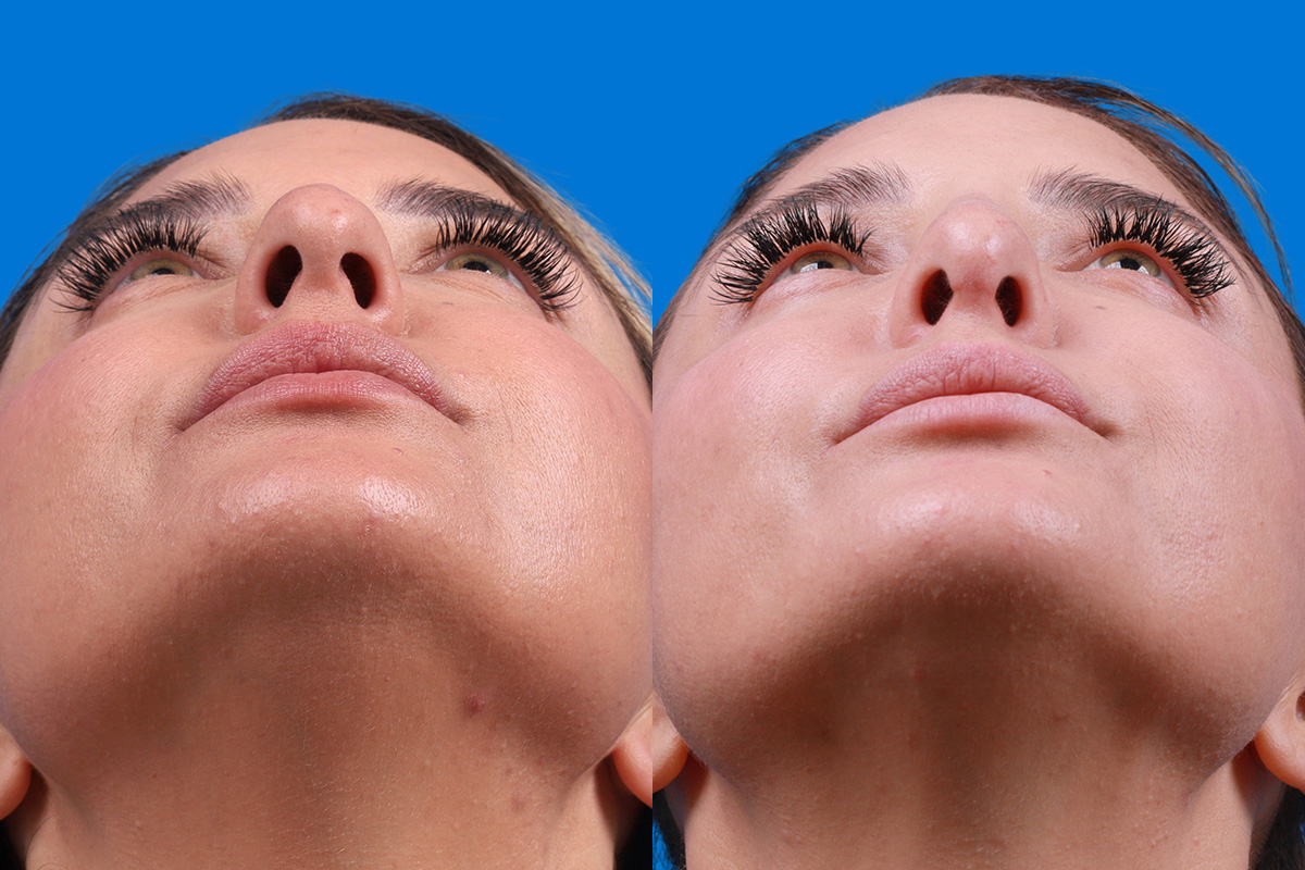 Rhinoplasty Before & After Gallery - Patient 354909 - Image 6