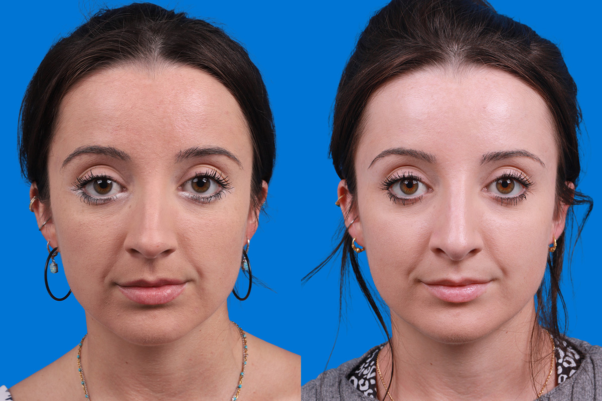 Rhinoplasty Before & After Gallery - Patient 210834 - Image 1