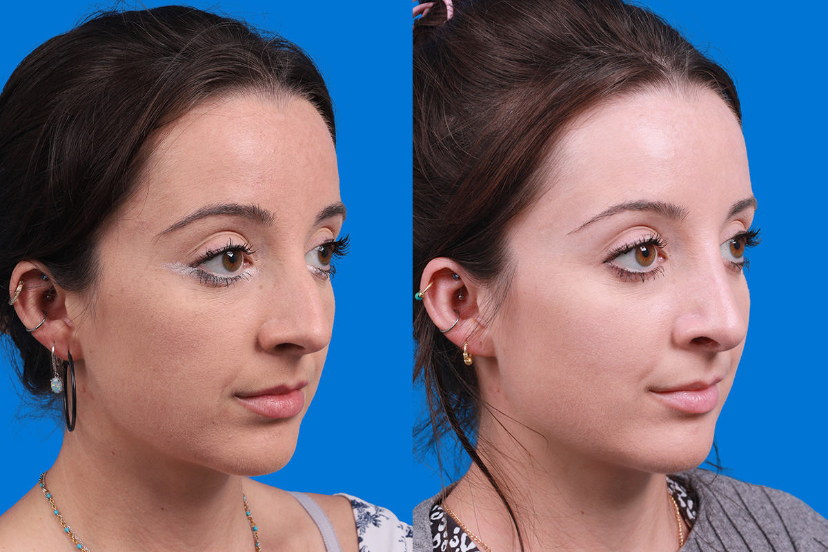 Rhinoplasty Before & After Gallery - Patient 210834 - Image 2