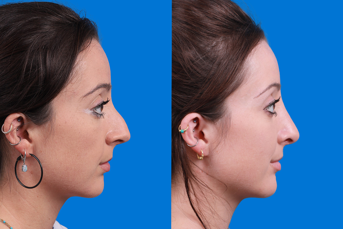 Rhinoplasty Before & After Gallery - Patient 210834 - Image 3