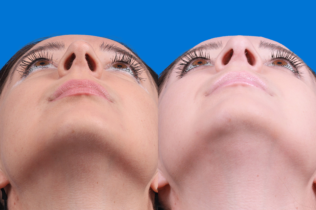 Rhinoplasty Before & After Gallery - Patient 210834 - Image 6