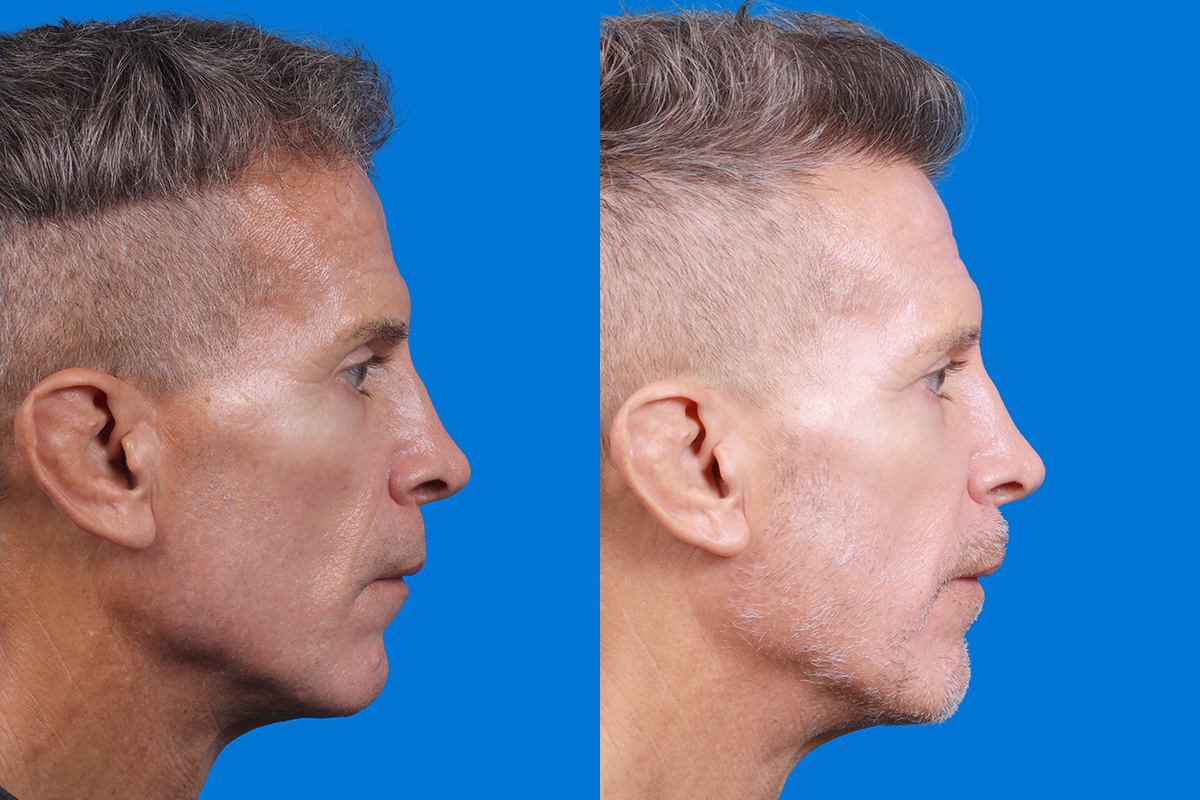 Hair Restoration Before & After Gallery - Patient 103873 - Image 3