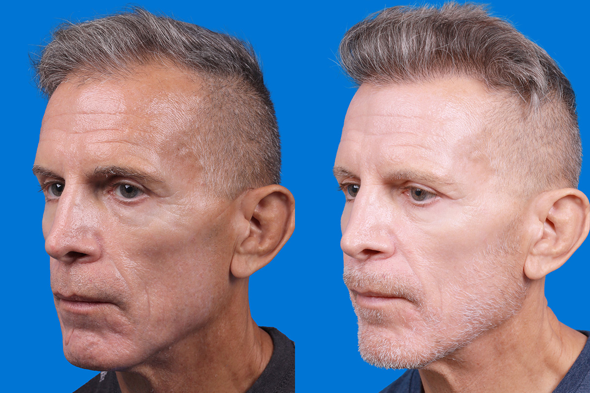 Hair Restoration Before & After Gallery - Patient 103873 - Image 4
