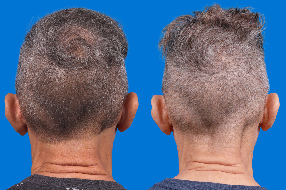 Hair Restoration Before & After Gallery - Patient 103873 - Image 8