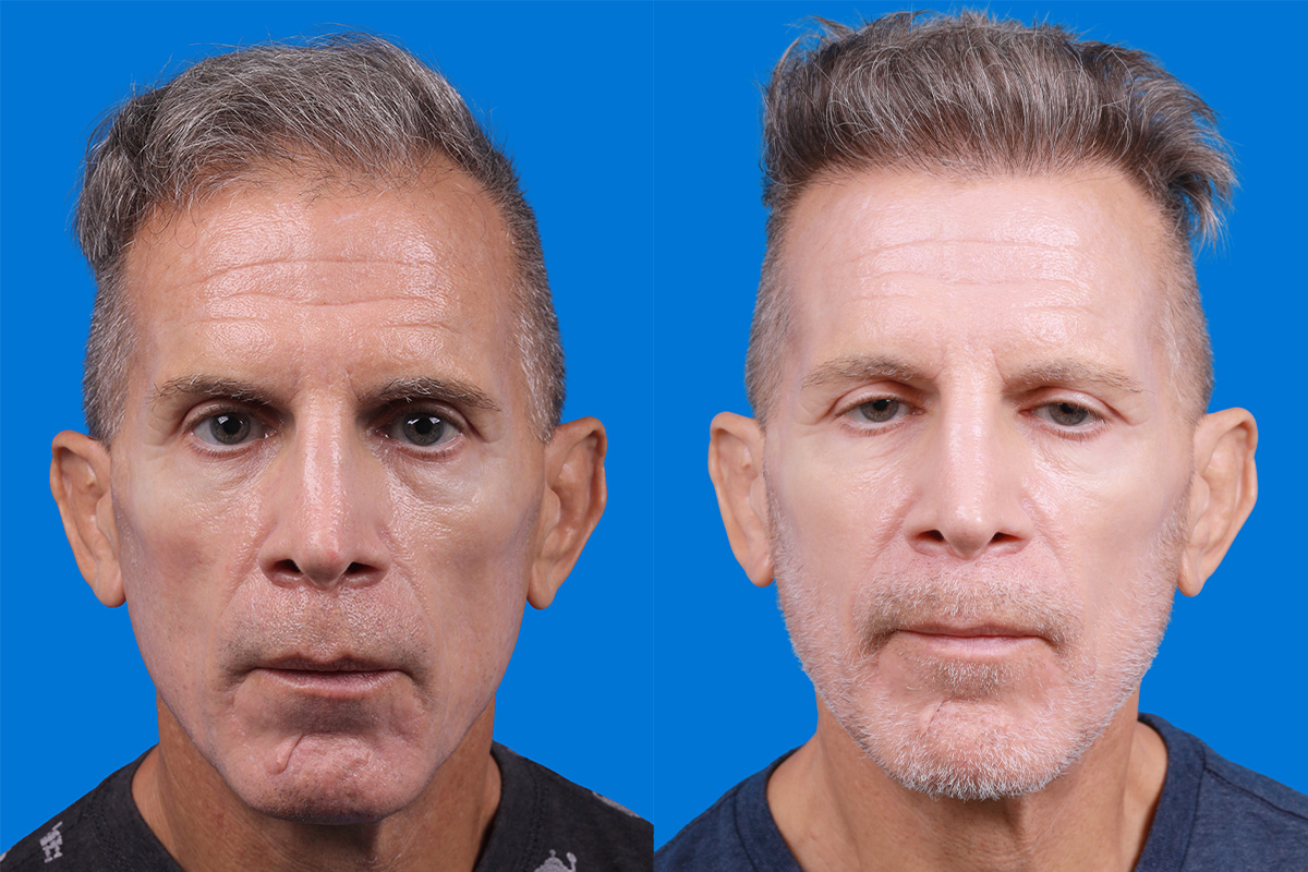 Hair Restoration Before & After Gallery - Patient 103873 - Image 1
