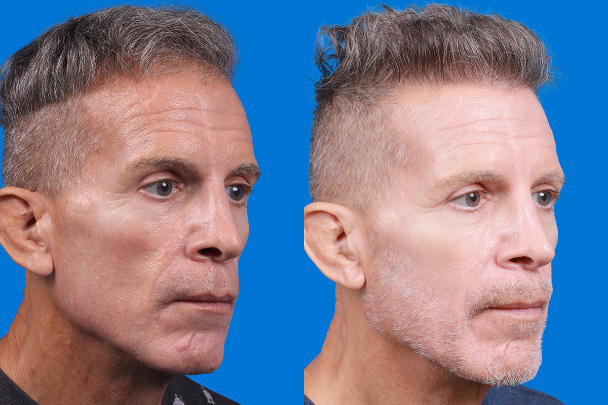 Hair Restoration Before & After Gallery - Patient 103873 - Image 2