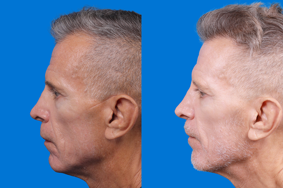 Hair Restoration Before & After Gallery - Patient 103873 - Image 5