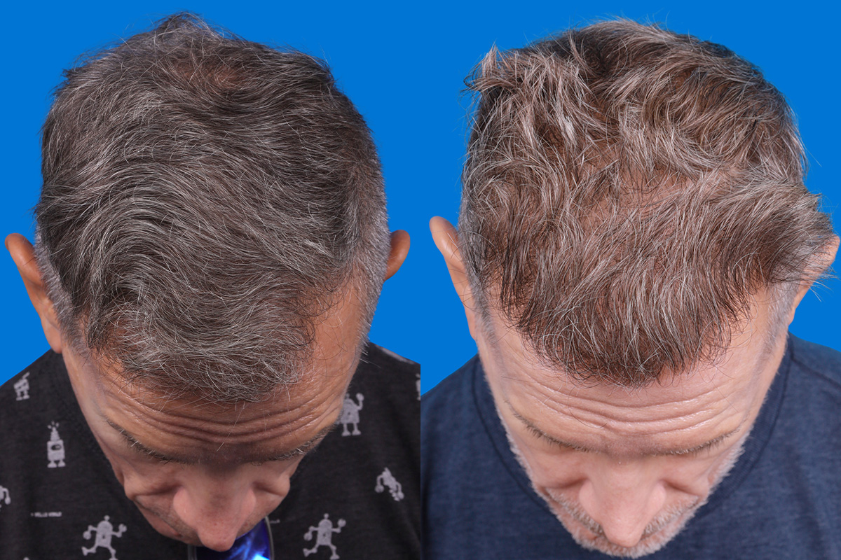 Hair Restoration Before & After Gallery - Patient 103873 - Image 6