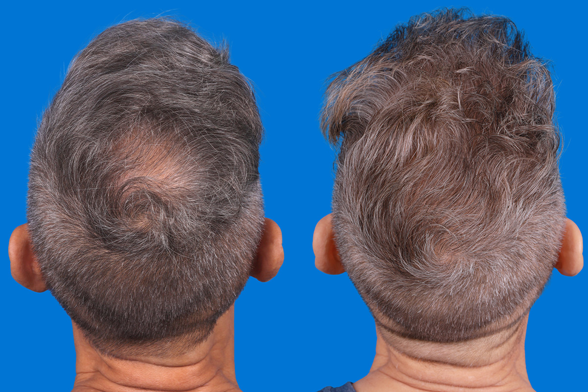 Hair Restoration Before & After Gallery - Patient 103873 - Image 7