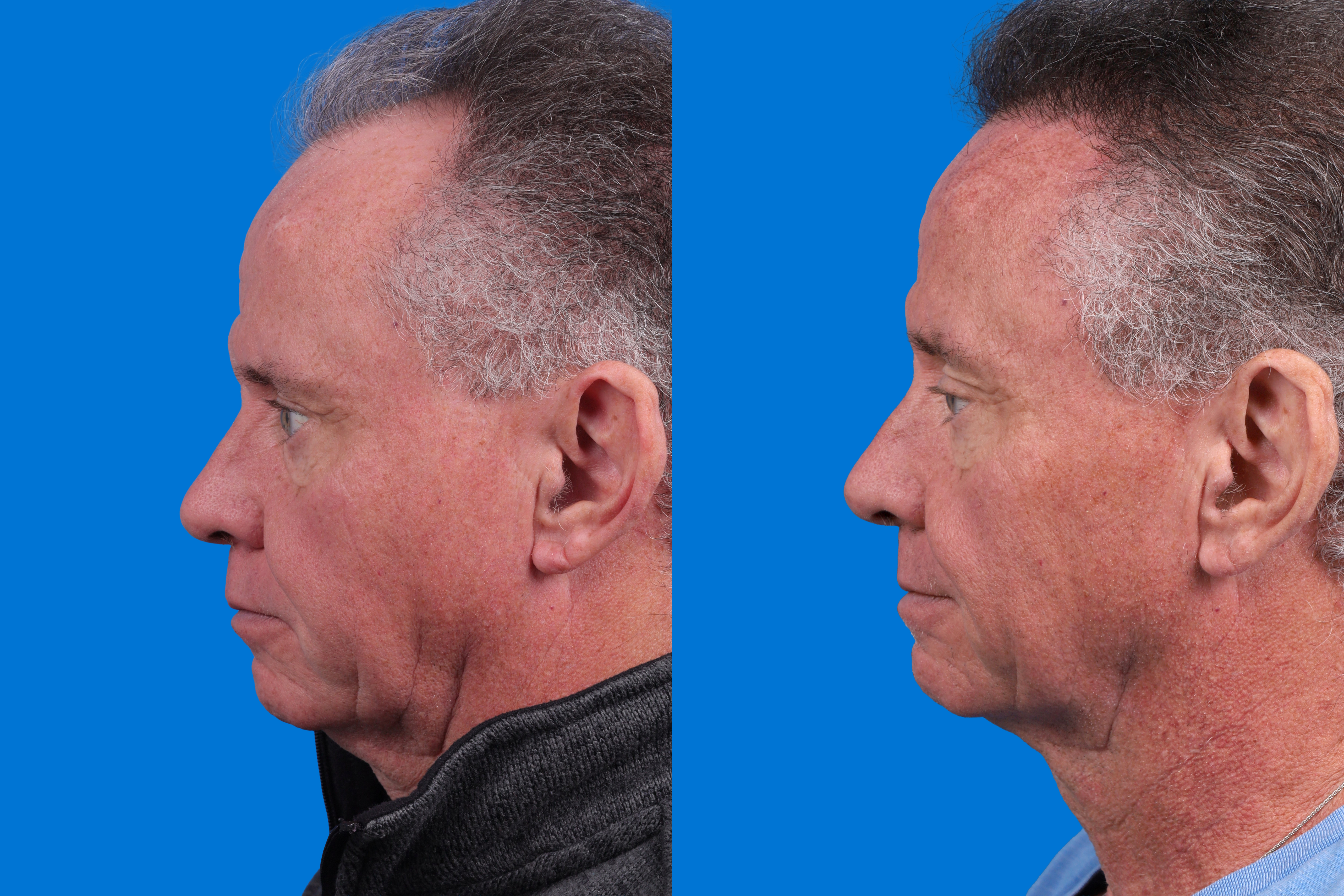 Hair Restoration Before & After Gallery - Patient 169556 - Image 5